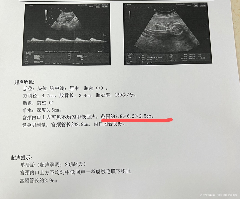 孕中期一直都有绒毛膜下积血断断续续出血三个月