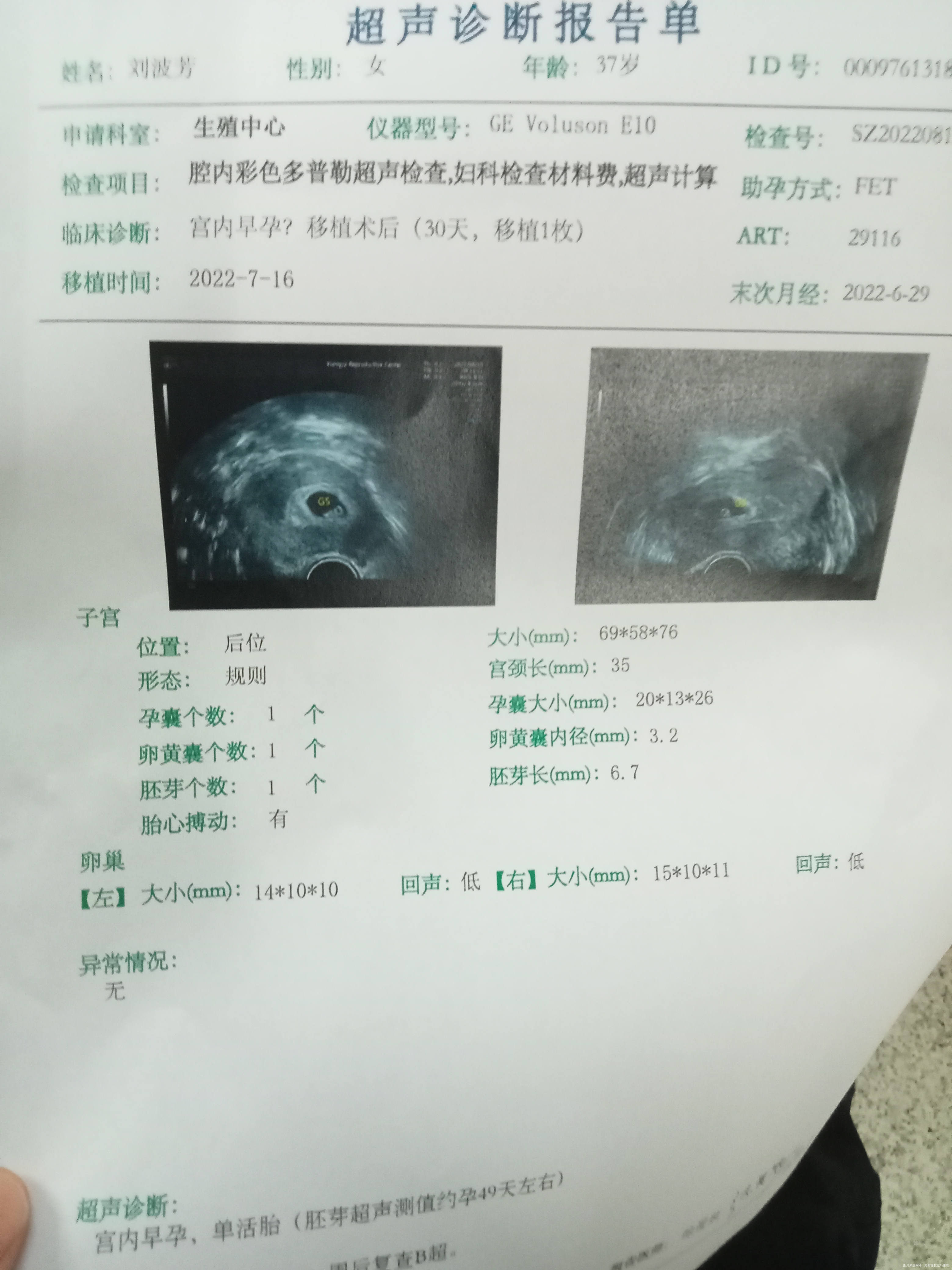 试管移植冻胚30天一超