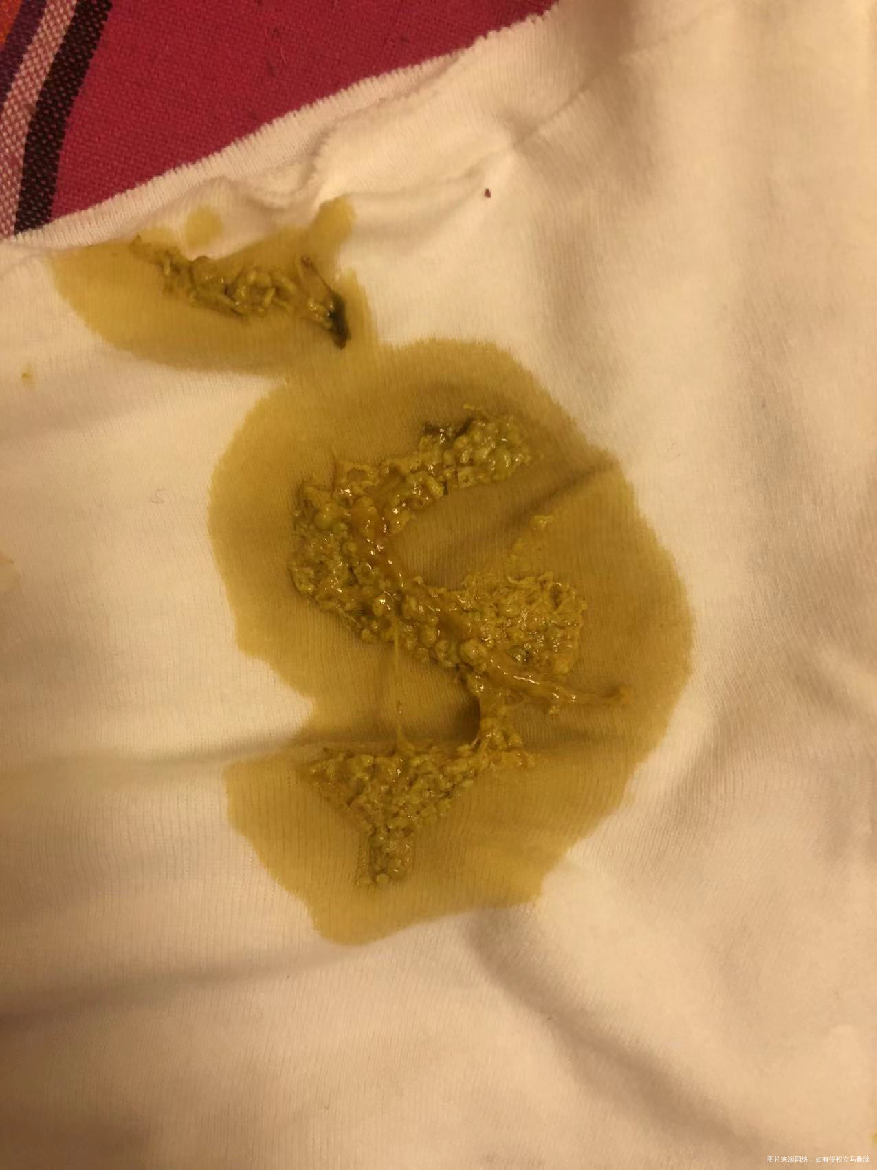 新生儿拉的颗粒状便便像米粒一样正常吗用不用去