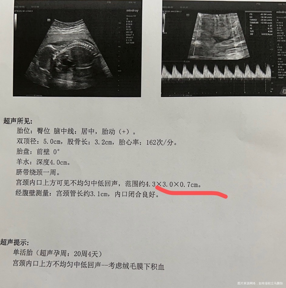 孕中期一直都有绒毛膜下积血断断续续出血三个月