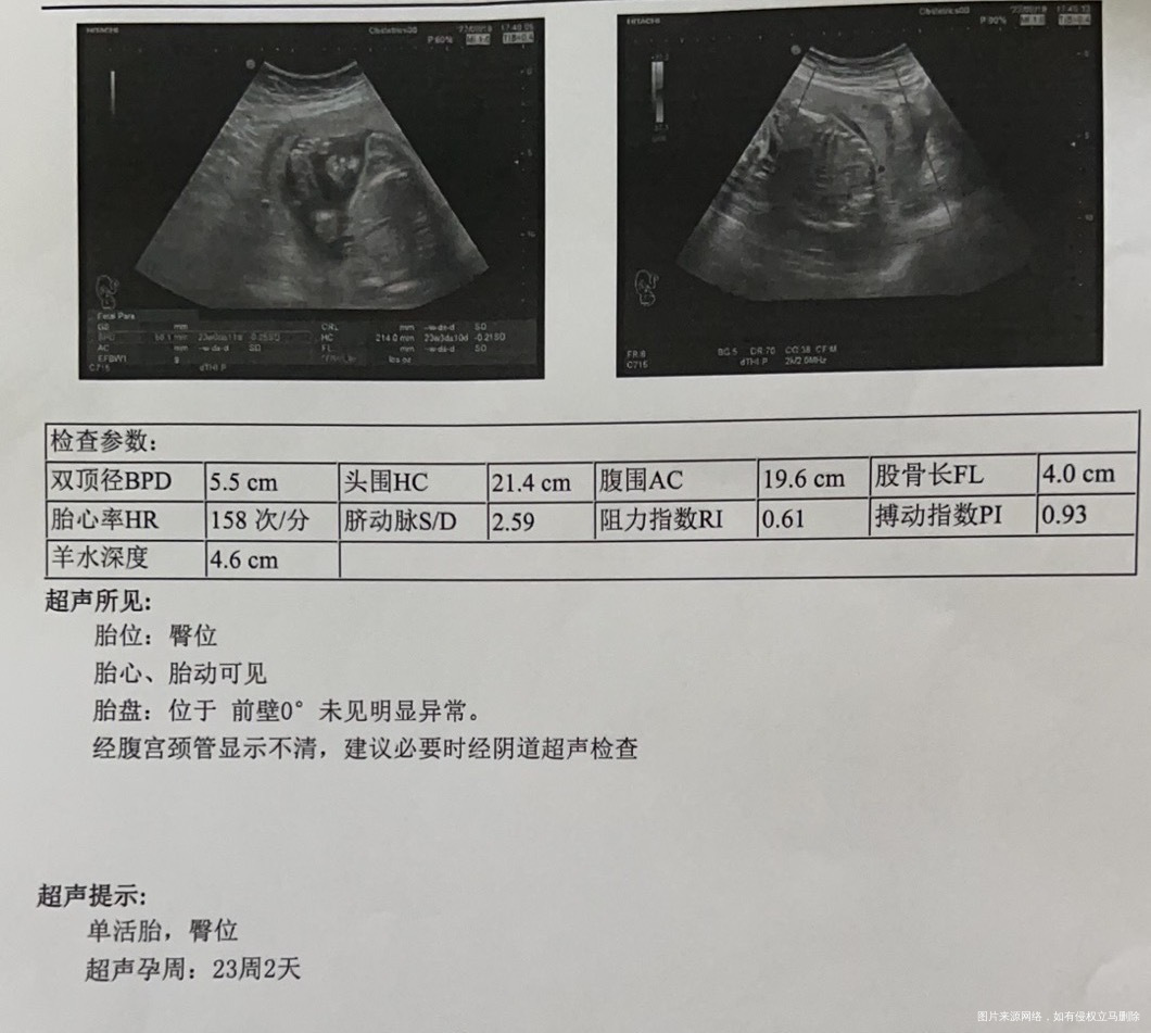 孕中期一直都有绒毛膜下积血断断续续出血三个月