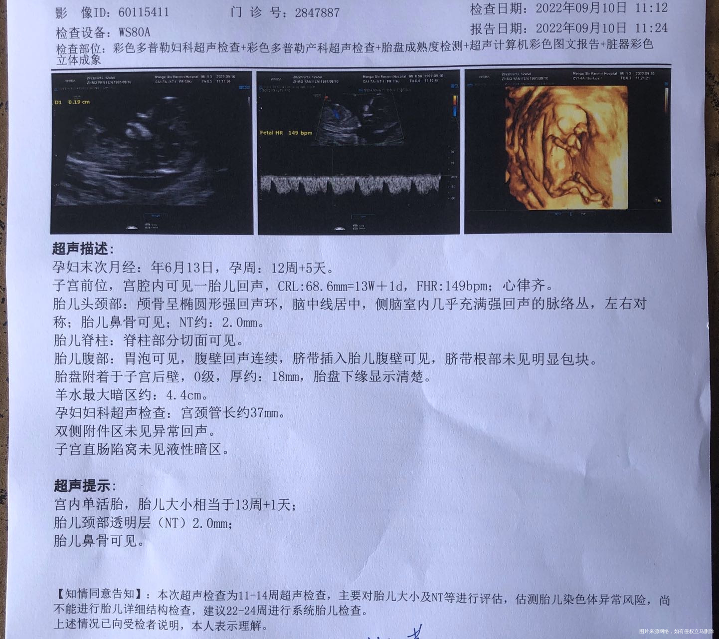 Nt已过31岁目前一般是选择做唐筛还是无创啊