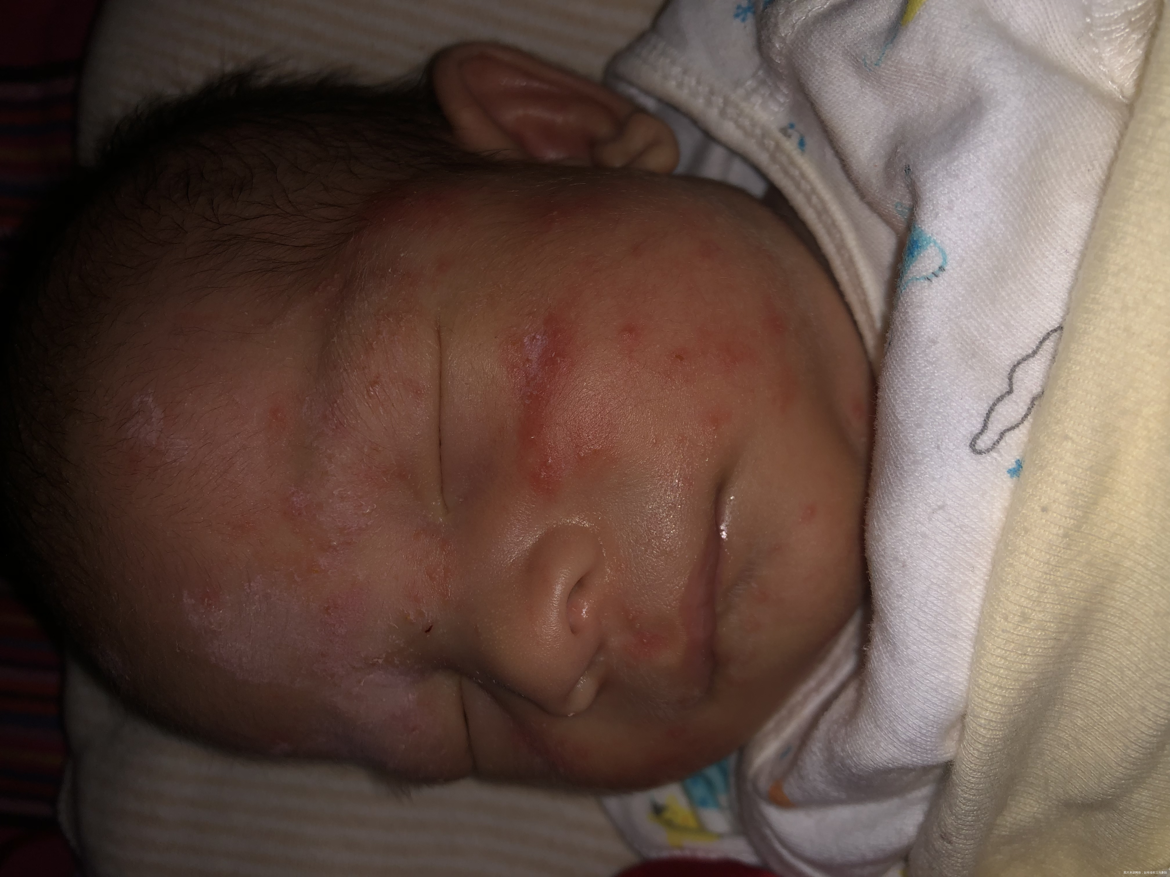 孩子脸上起来很多火疙瘩上面还有小白脓点这怎么