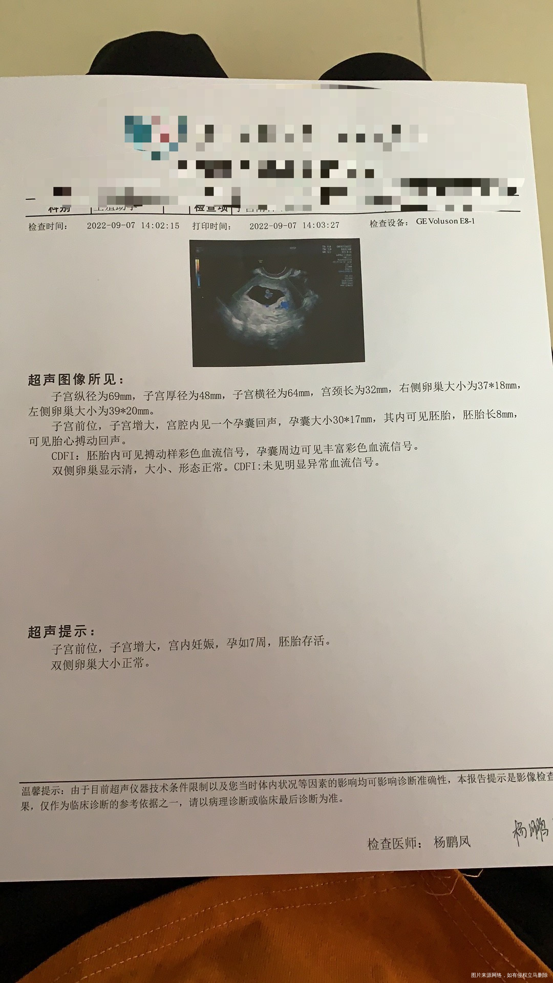 囊胚移植29天B超有胎心了医生说宝宝挺好的交