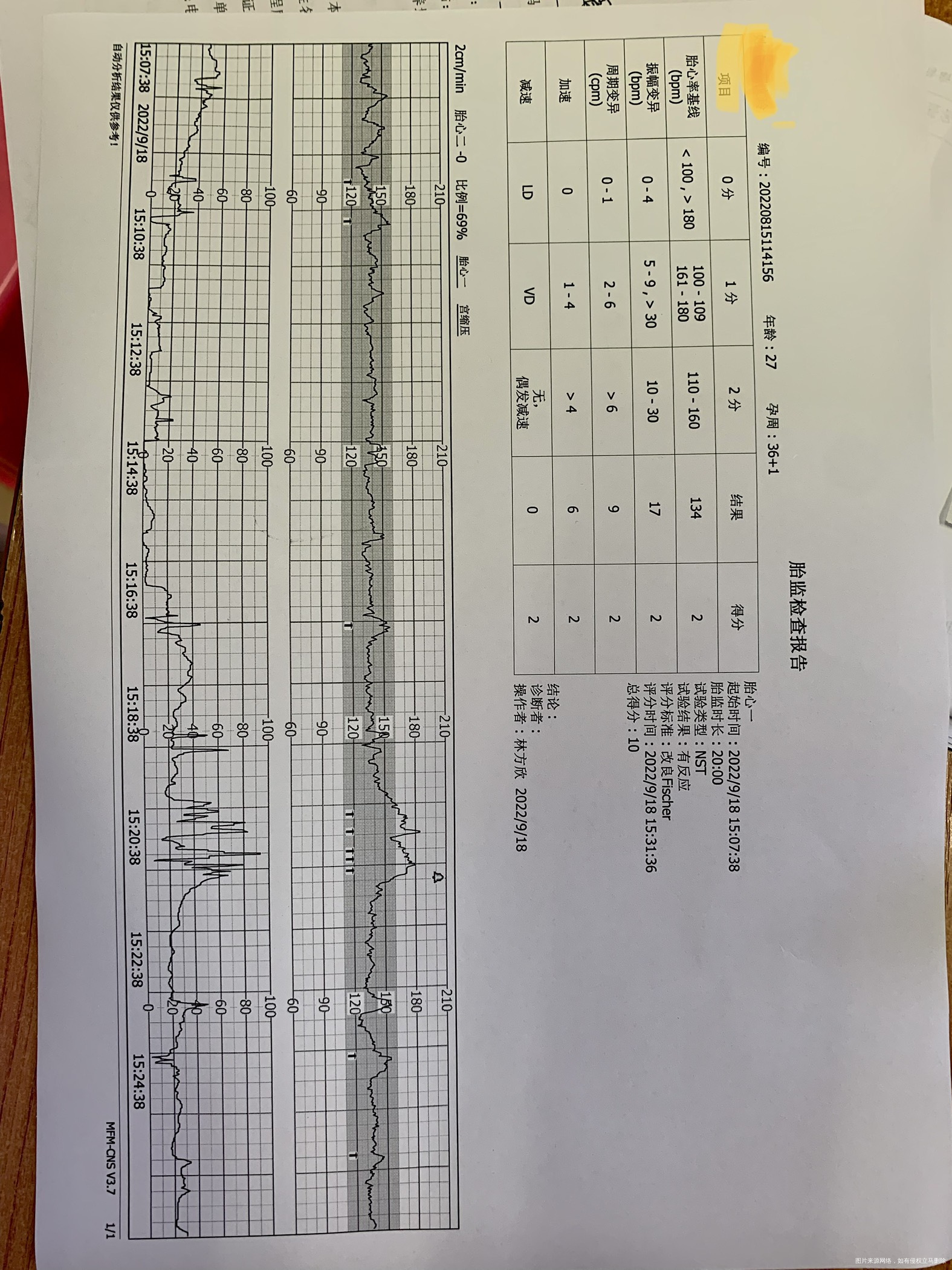 帮忙看看胎监的结果谢谢