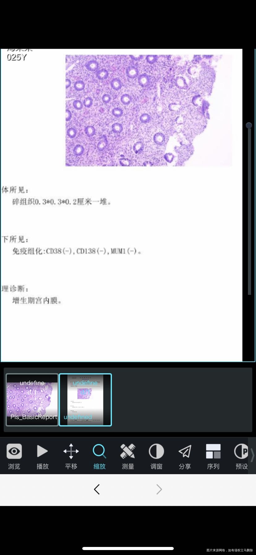 移植一次4aa囊胚失败做的宫腔镜病理请问正常
