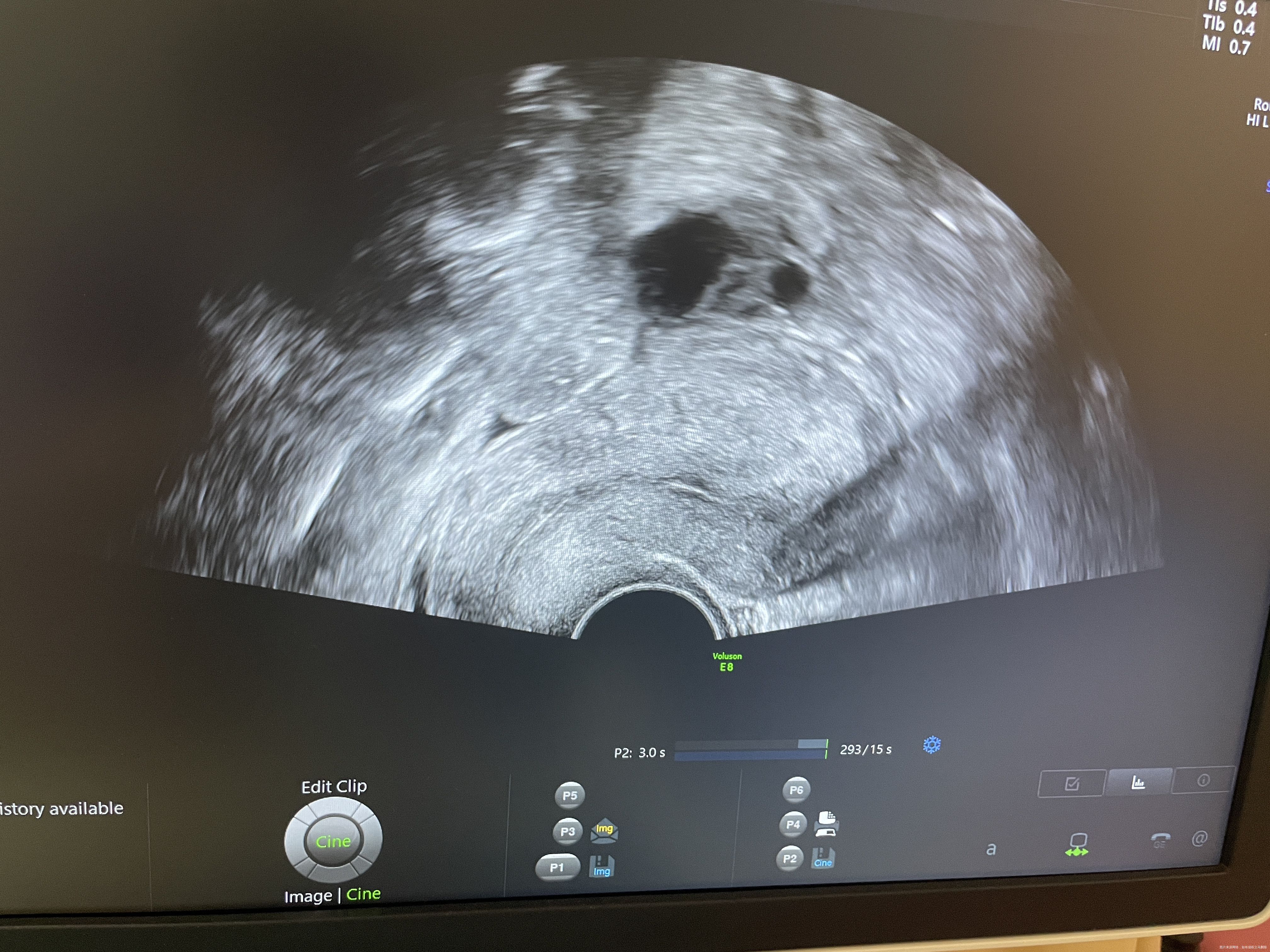 请问医生这个内膜适合移植不