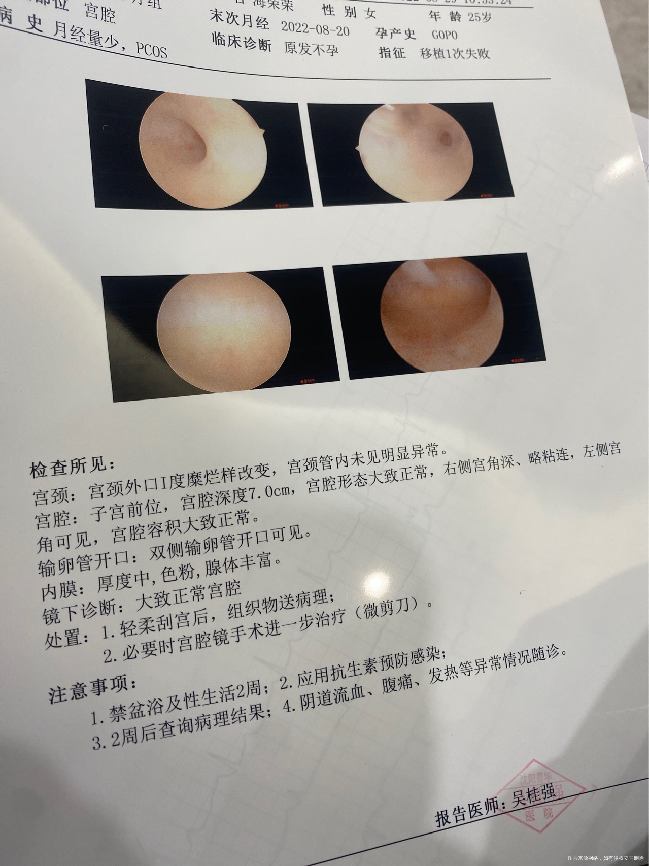 移植一次4aa囊胚失败做的宫腔镜病理请问正常