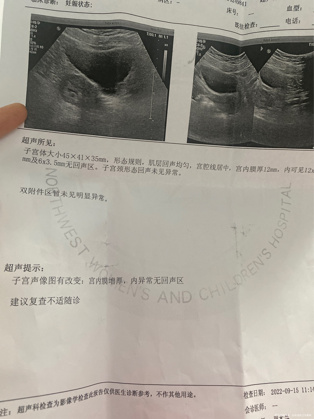 这个单子能看出啥有两个回声区是啥意思