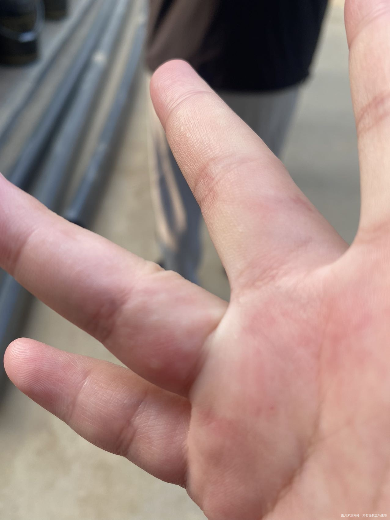 疫情期间封在家里了手上突然起了一下子这个泡泡