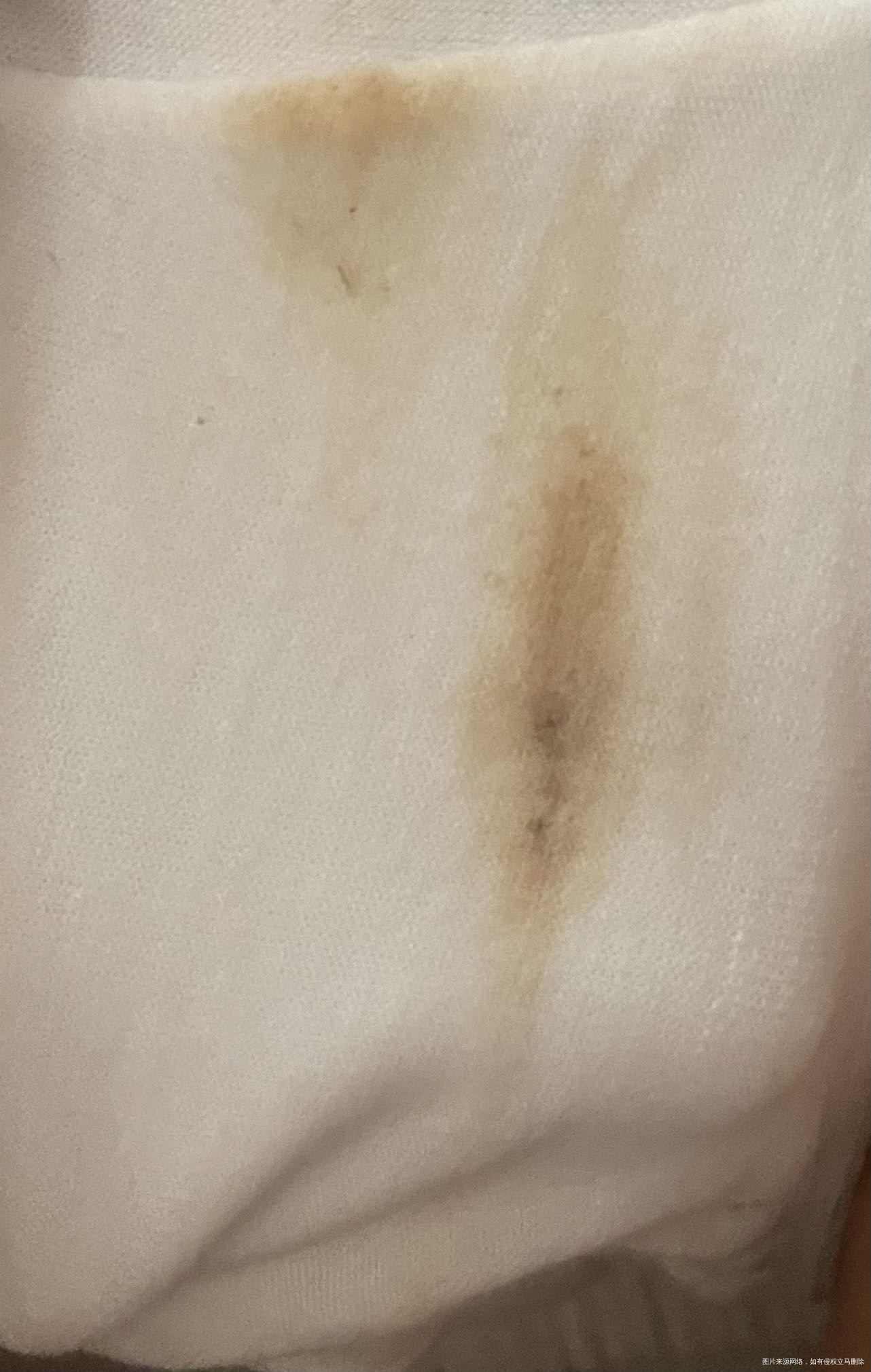 1012号移植胚胎~中了~今天突然发现白色内