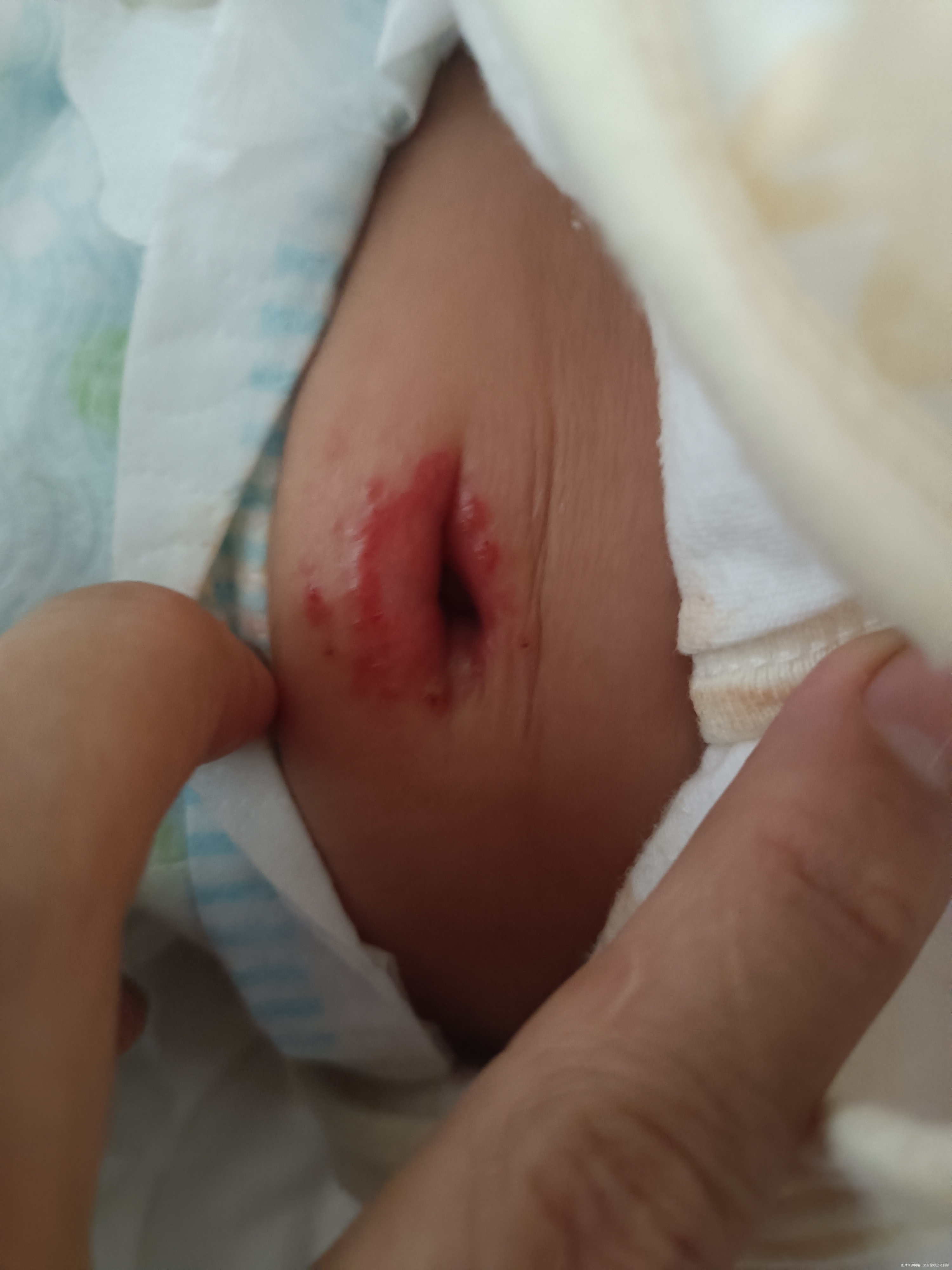 宝宝肚脐这样是怎么了该怎么办