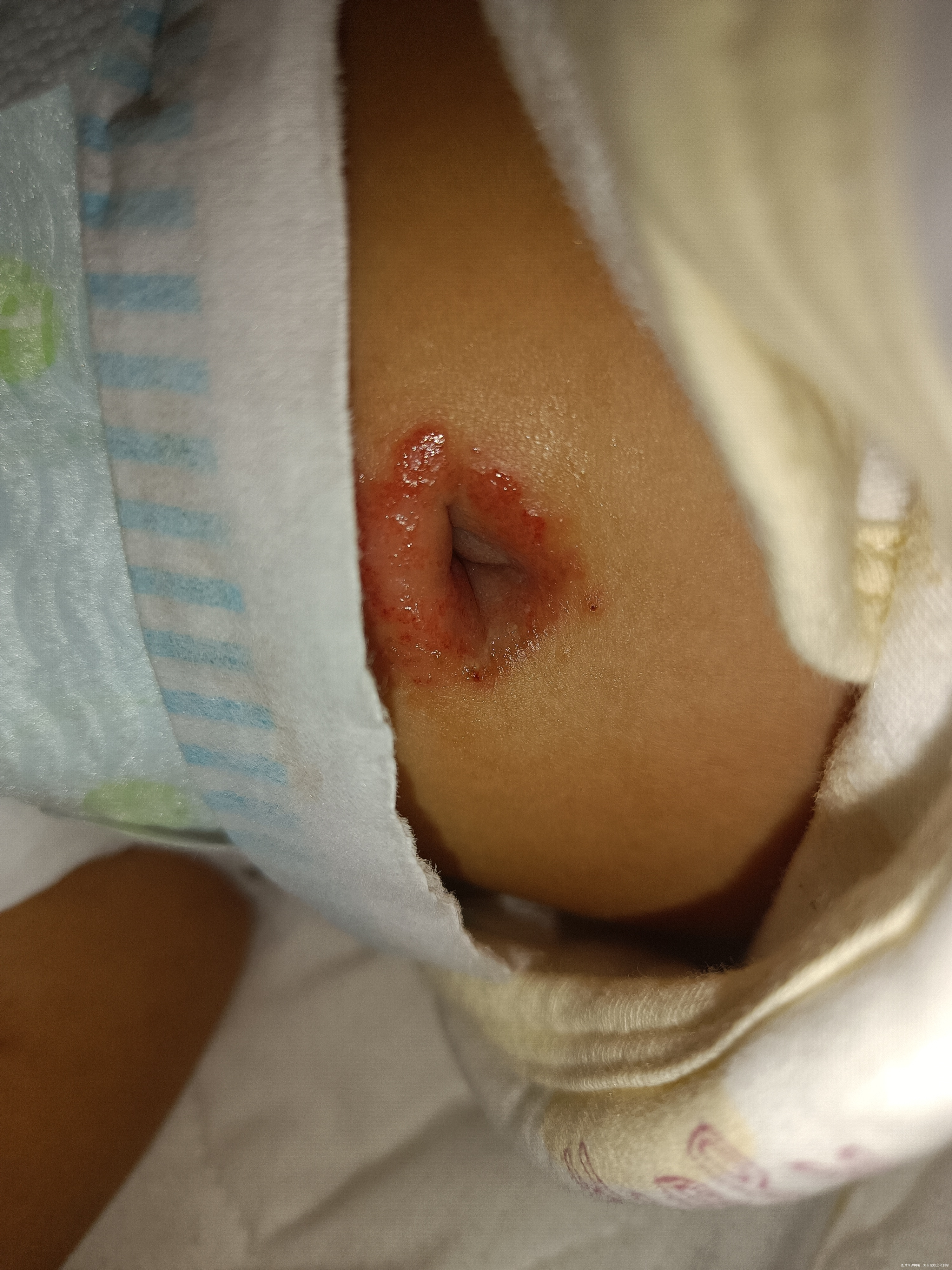 宝宝肚脐这样是怎么了该怎么办