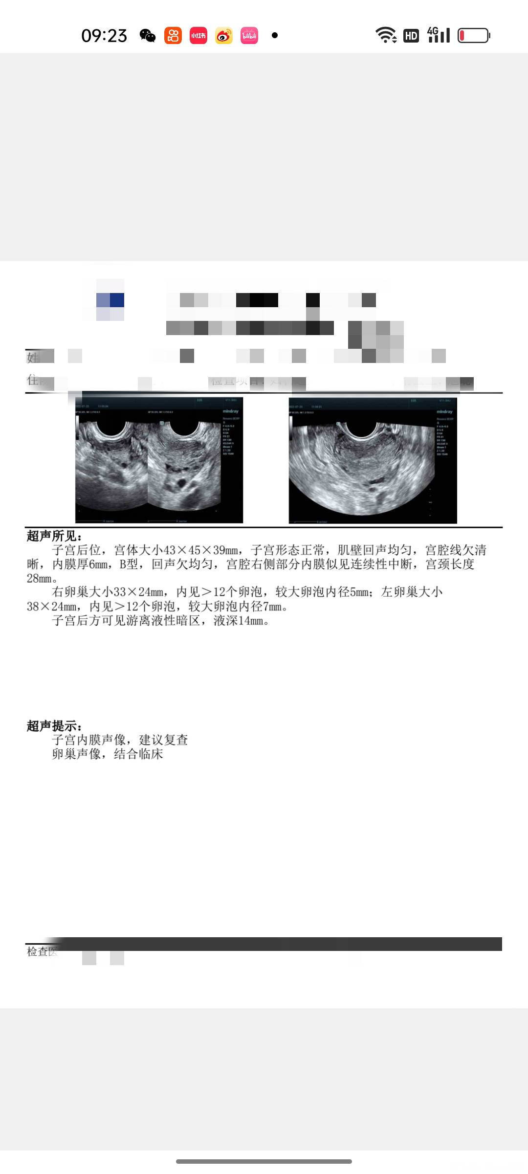 多囊超声造影显示双侧输卵管通而不畅一次孕史无