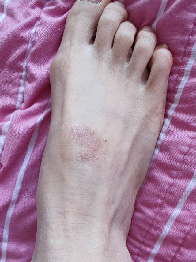 湿疹严重用了3次激素好了差不多了备孕有啥要求