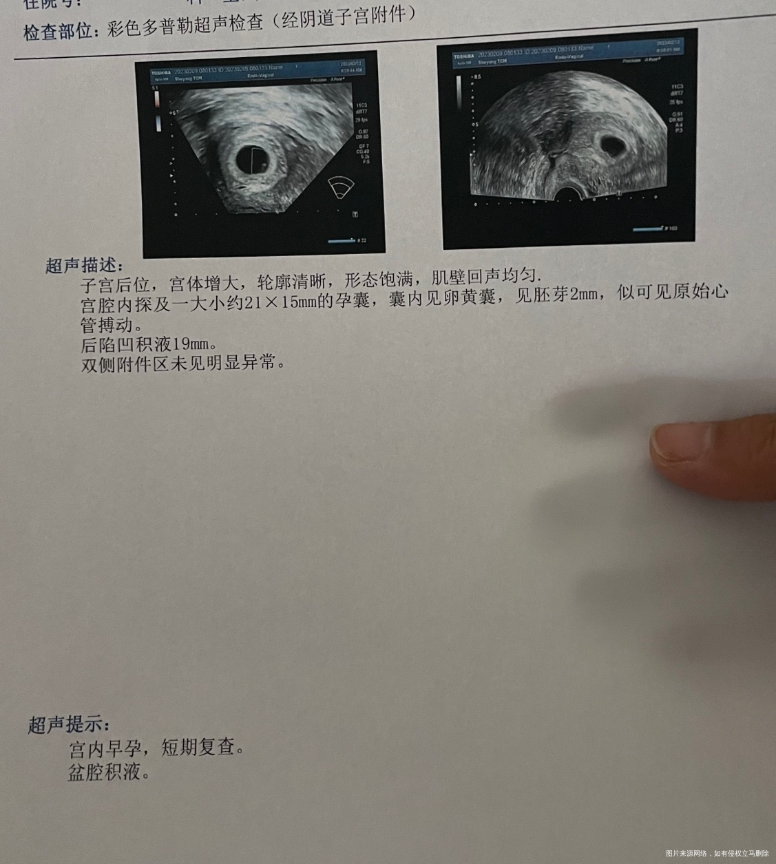 停经49天怀孕了盆腔积液有影响吗