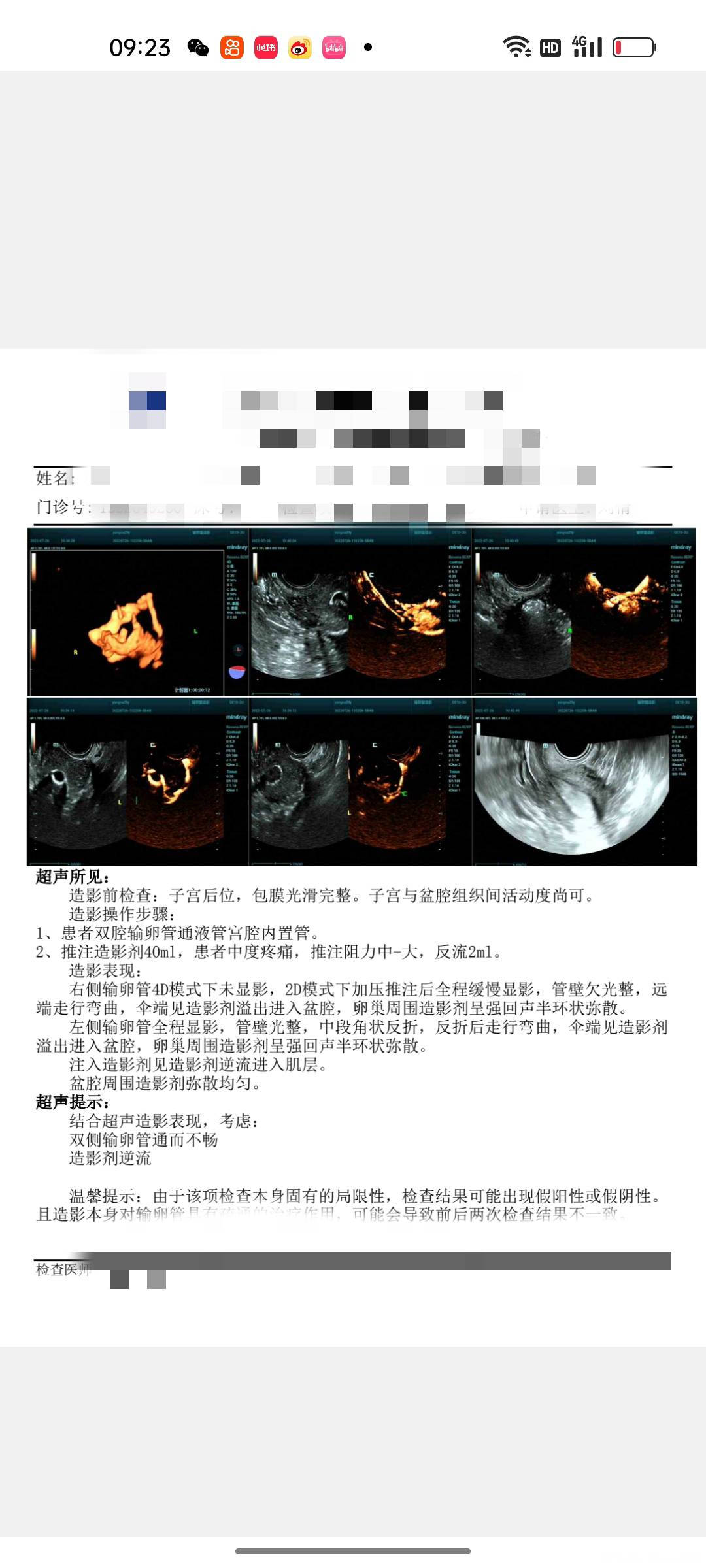 多囊超声造影显示双侧输卵管通而不畅一次孕史无