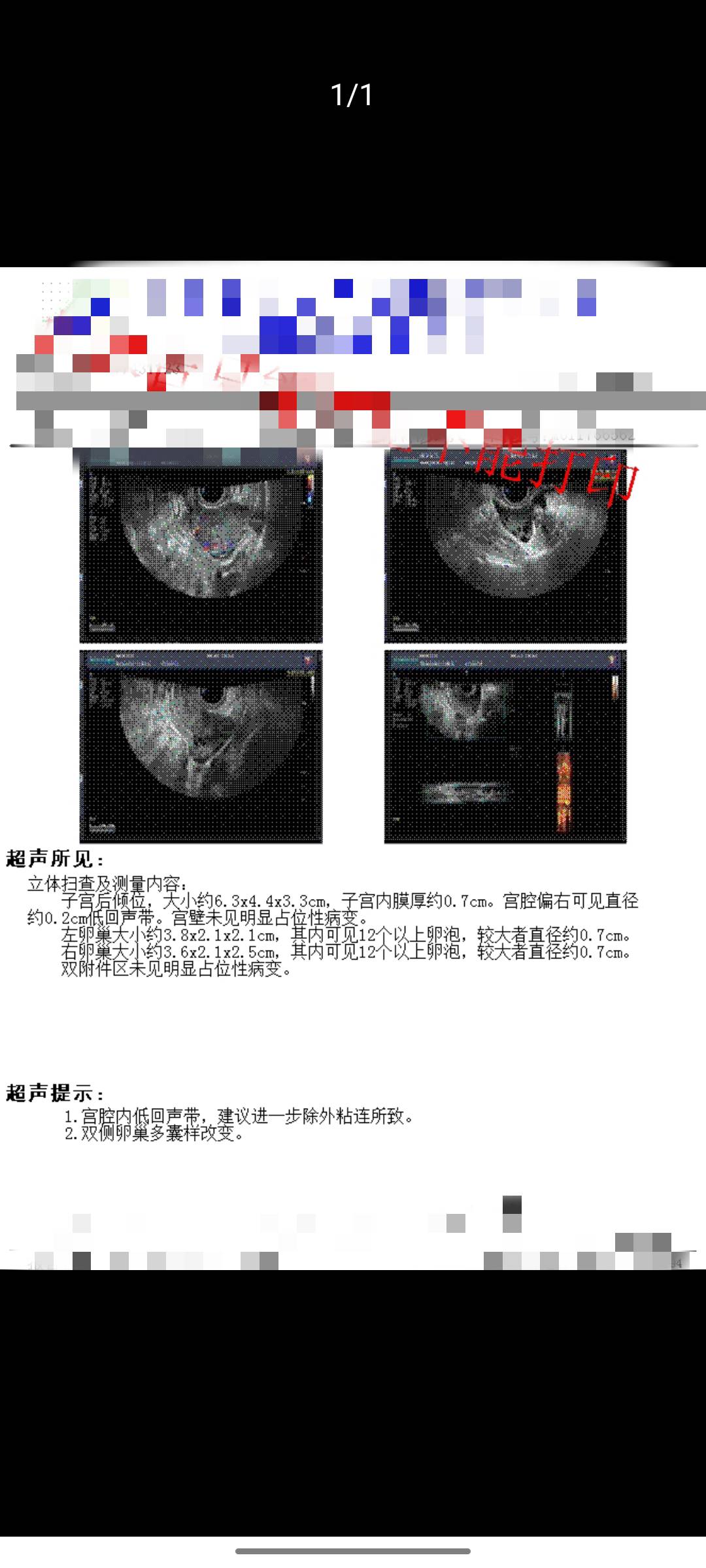 多囊超声造影显示双侧输卵管通而不畅一次孕史无
