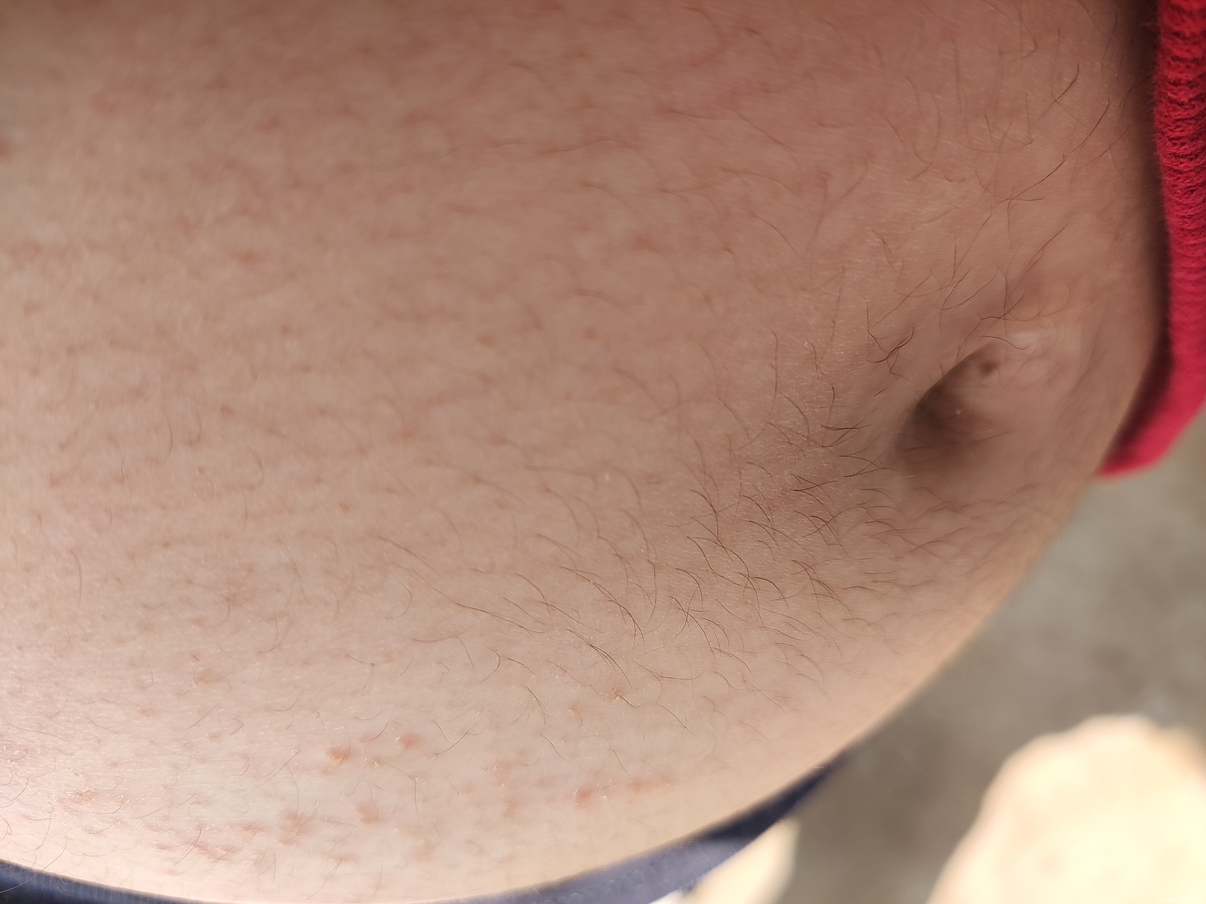 医生好我现在孕21周上周开始肚皮会发痒起红疹