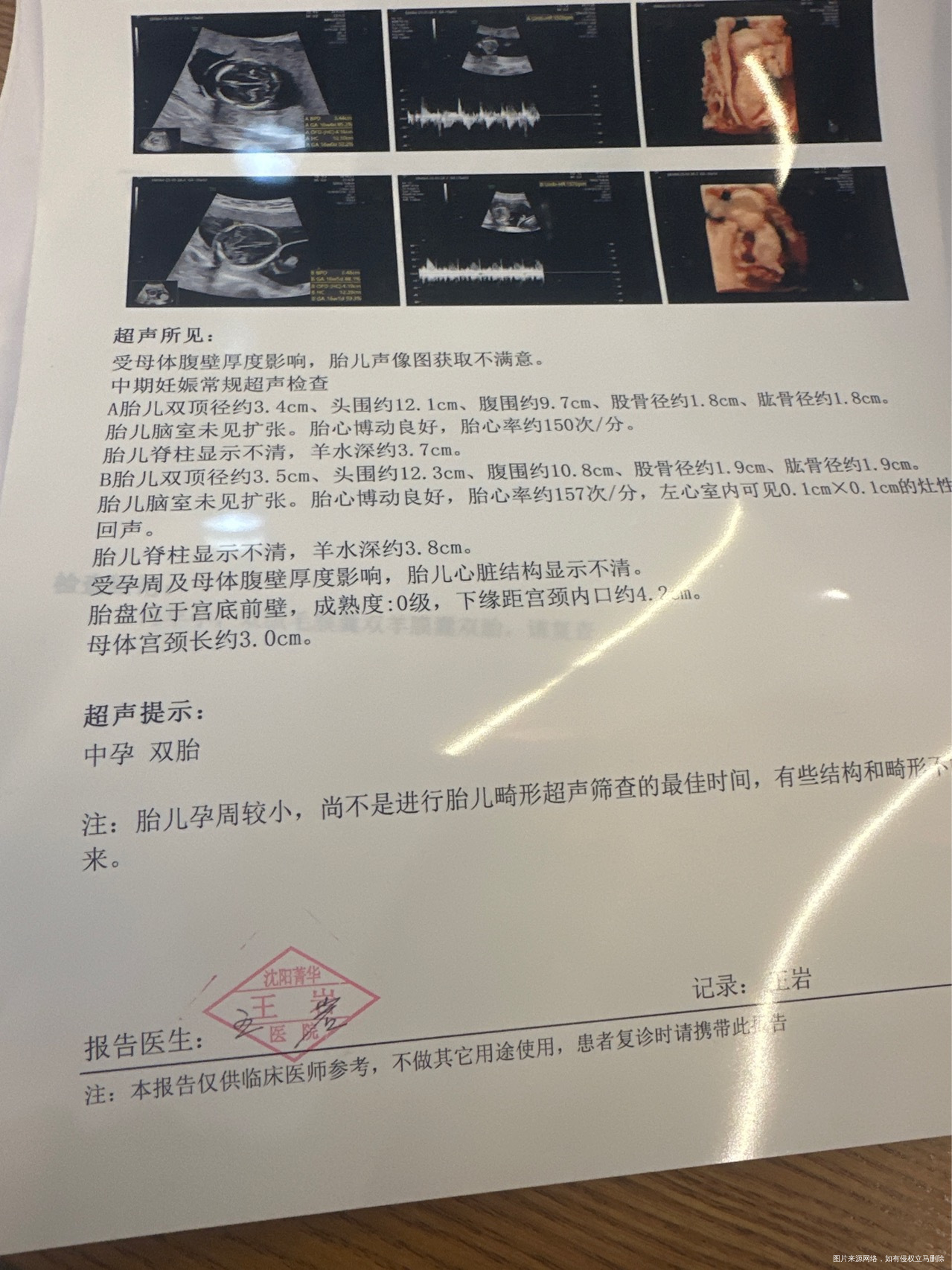 双胎15周6做了个b超b胎儿左心室01✖️0