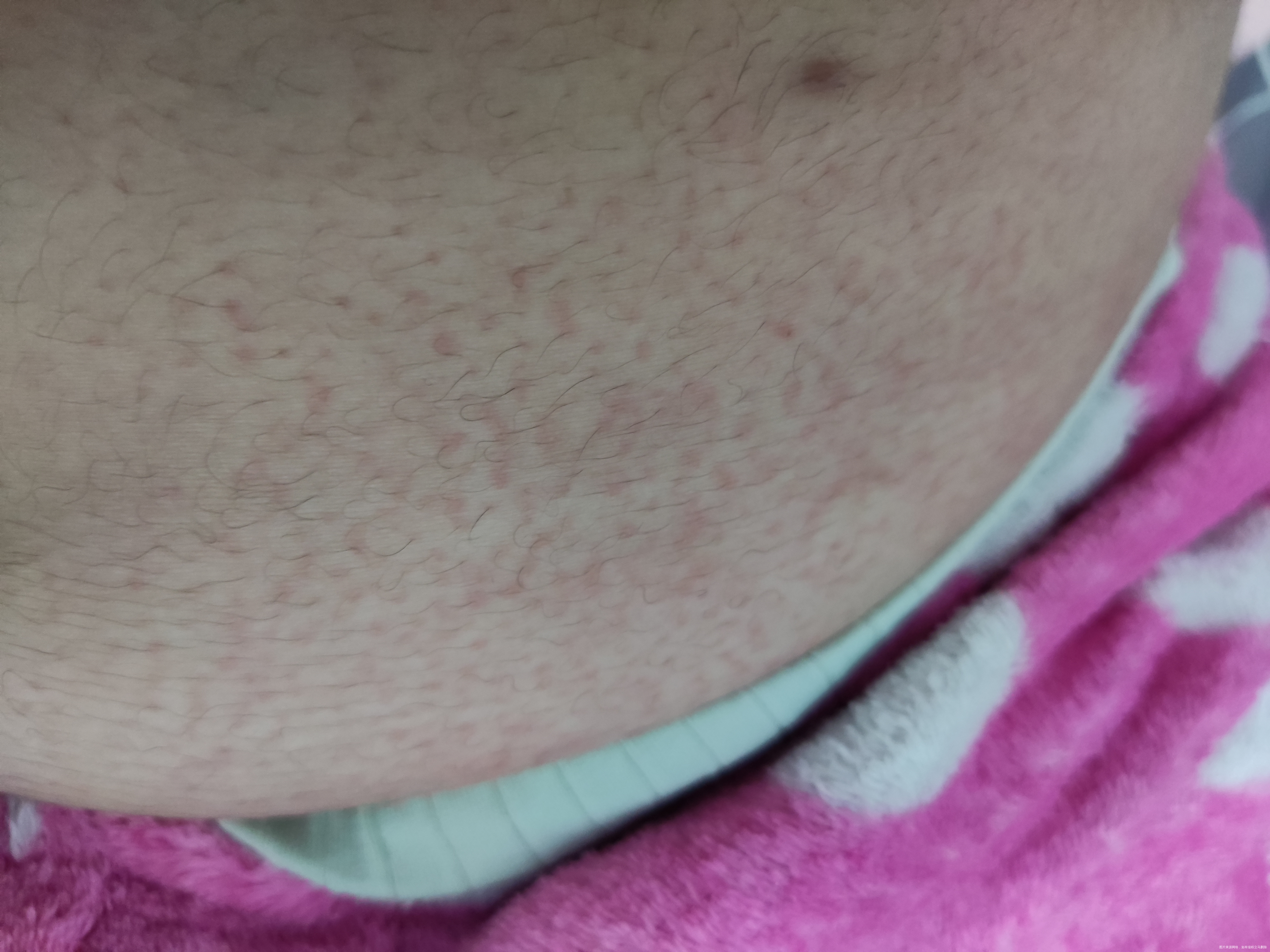 医生好我现在孕21周上周开始肚皮会发痒起红疹