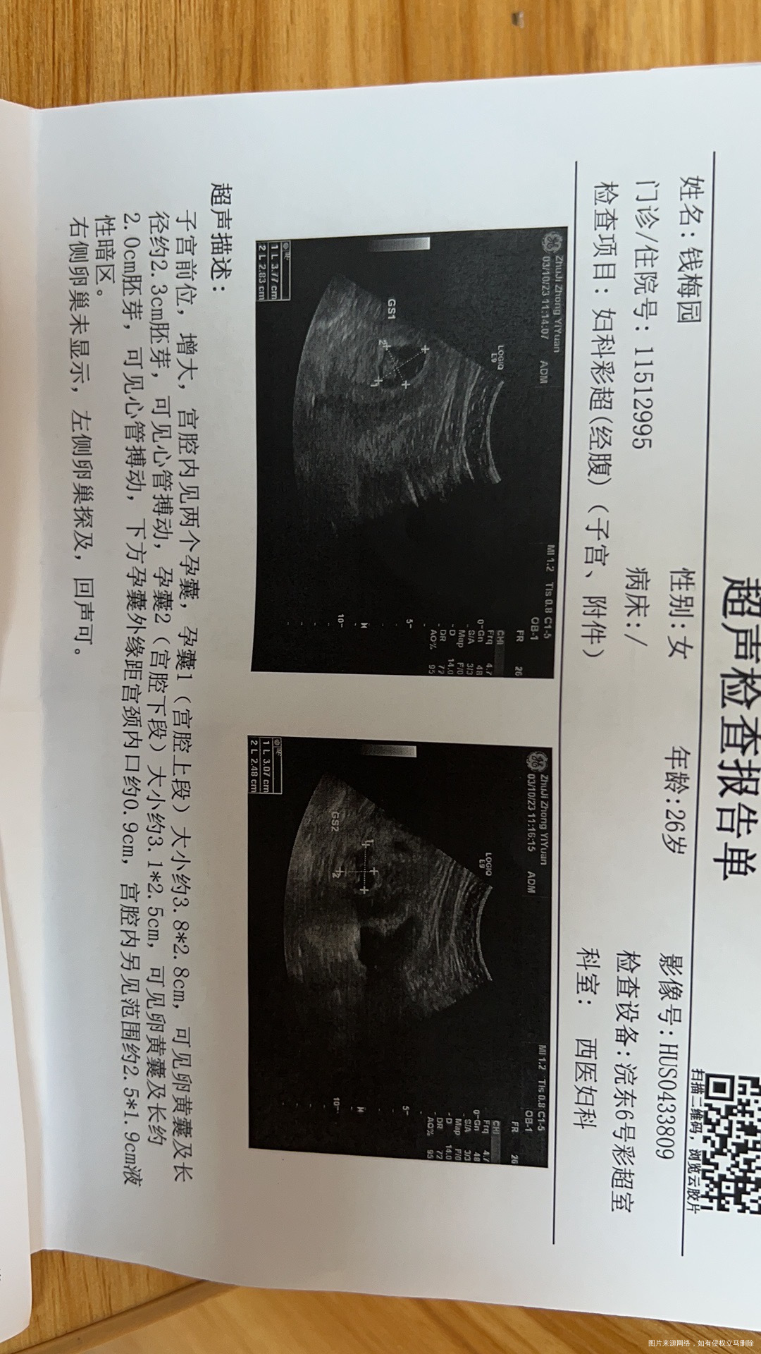 想问问我这种情况下端孕囊是不是很危险