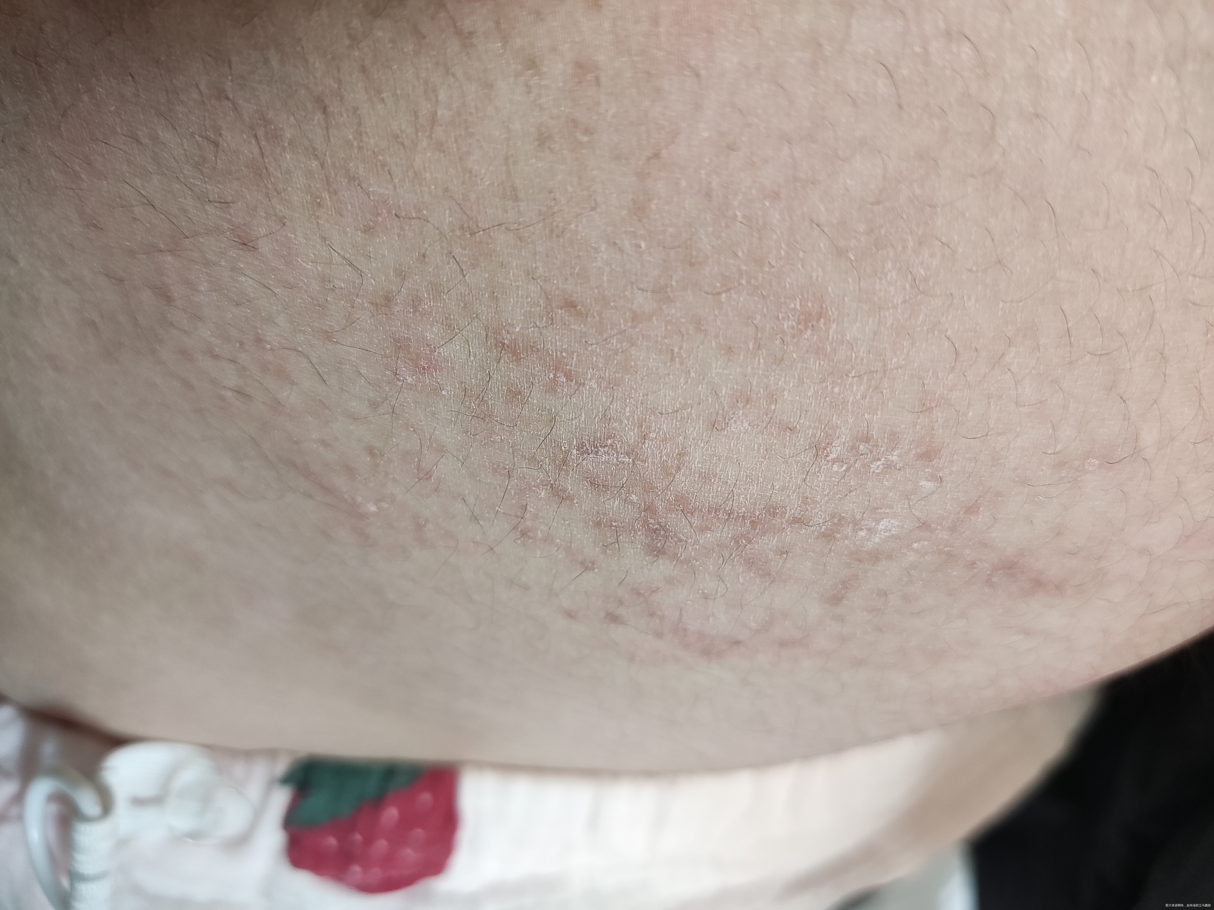 医生好我现在孕21周上周开始肚皮会发痒起红疹