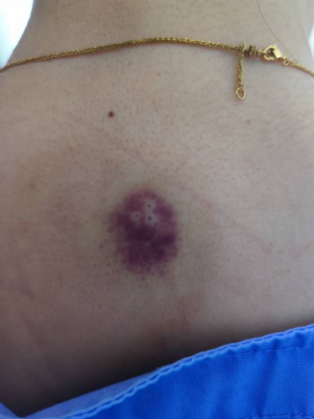 现在这个可以洗澡了吧过了2天了