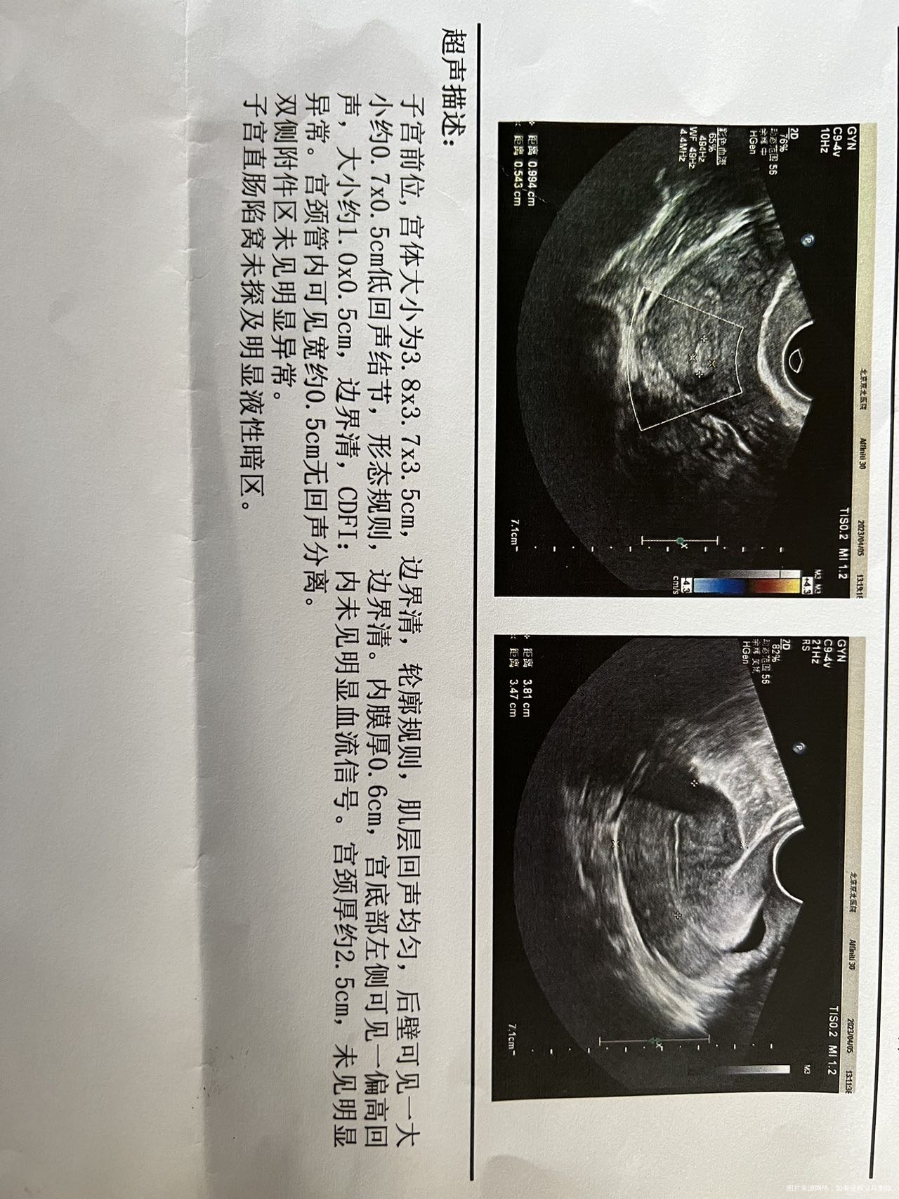 月经第十天B超检查子宫有个10厘米息肉上个月