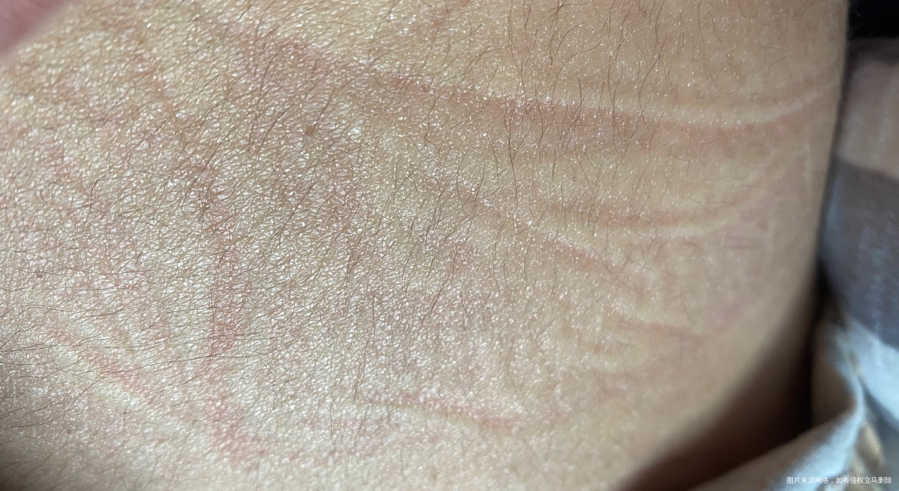 24周侧着睡觉肚子被裤子压的都是印子要不要紧