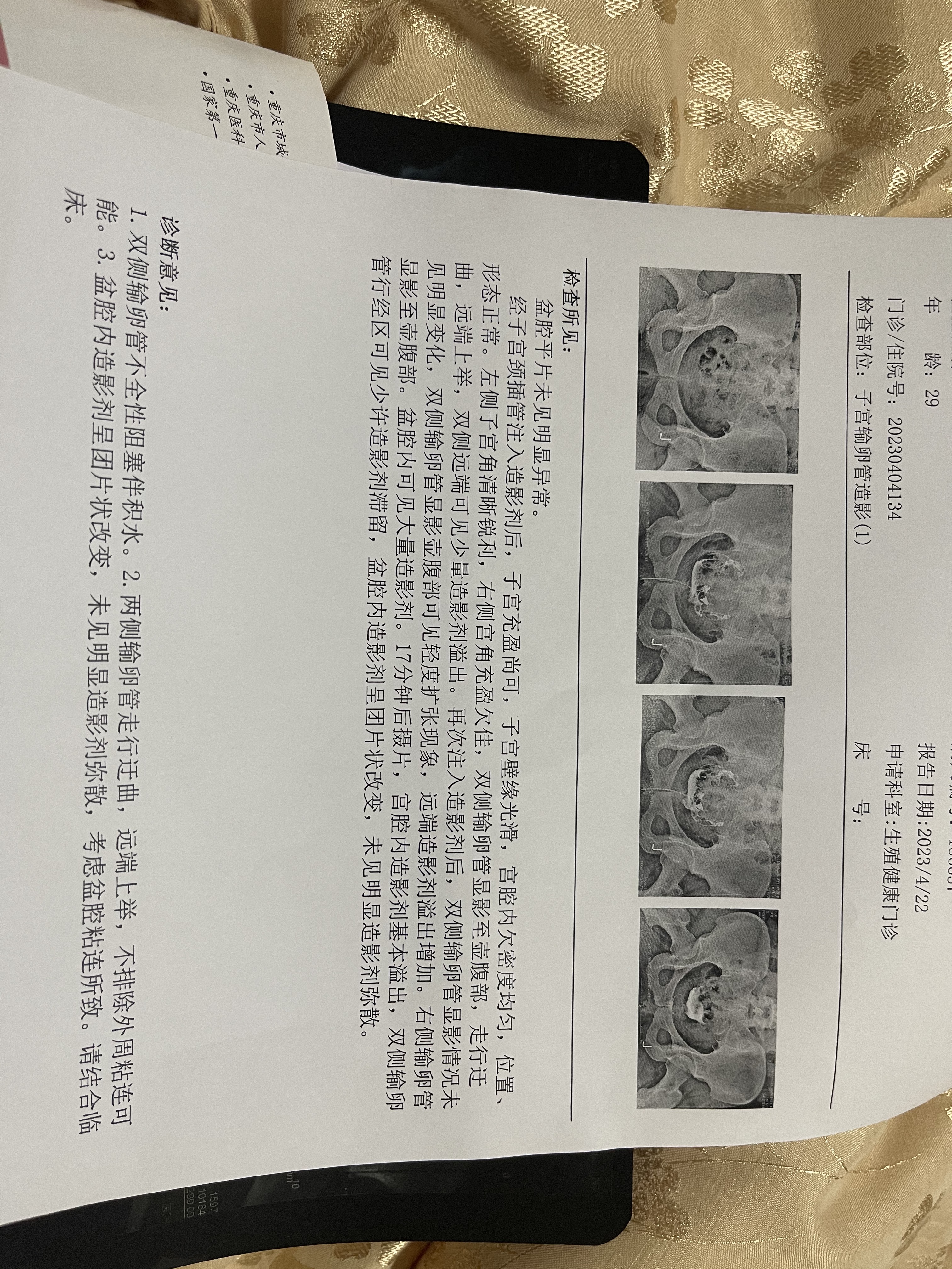 您好我2018年胎停过清宫后一直未怀去做了各