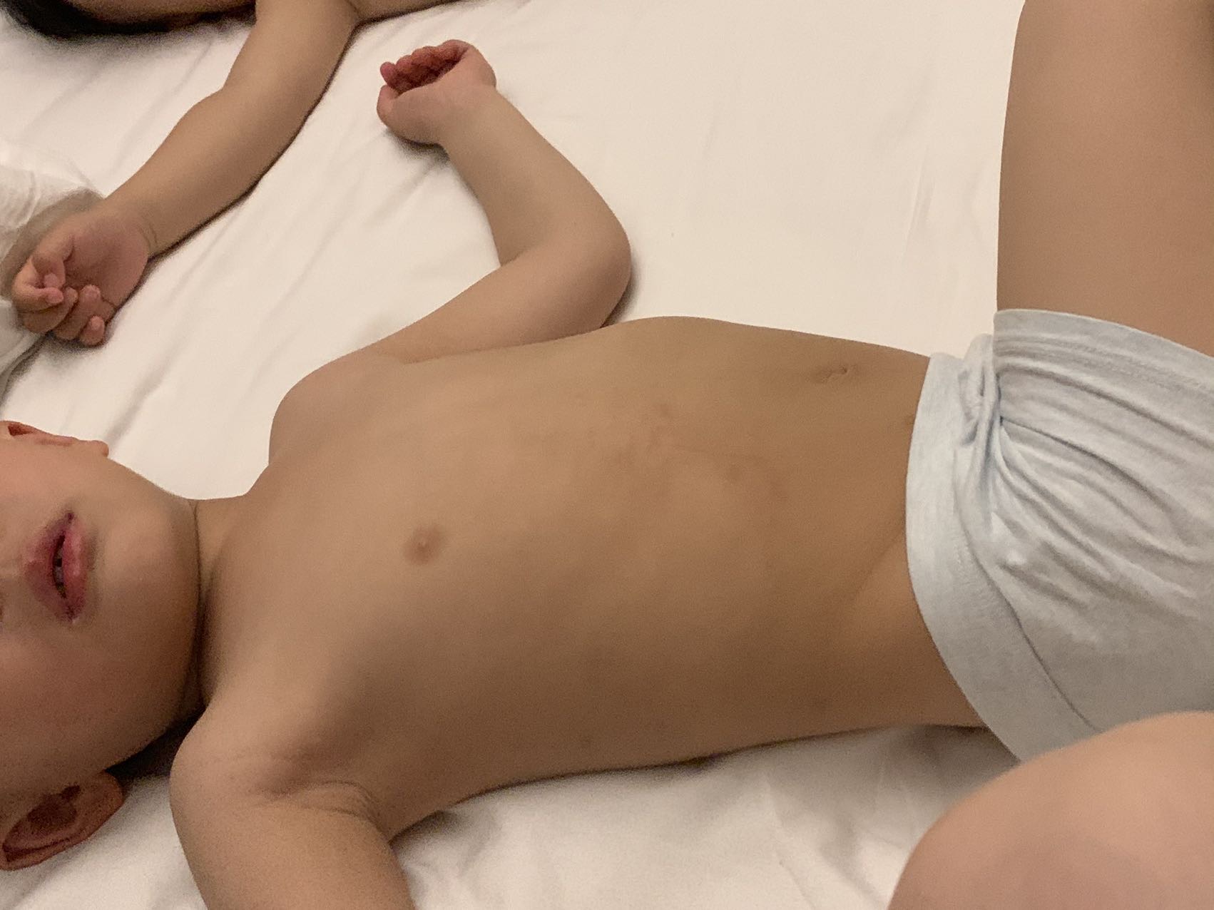 图1图2是我宝宝肚子上两根骨头好高图3⃣️是