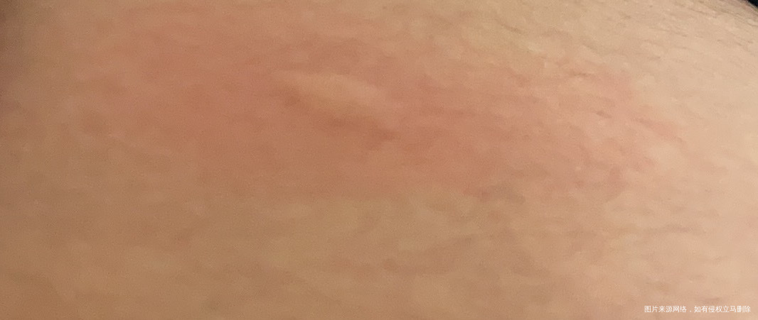 孕期住院就上个厕所功夫肚子上被咬了个大包痒死