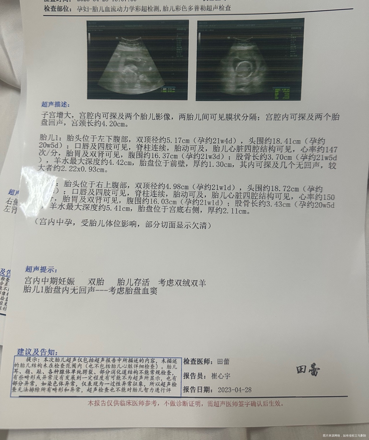 试管双胎21周有血20周的时候出鲜血住院了b