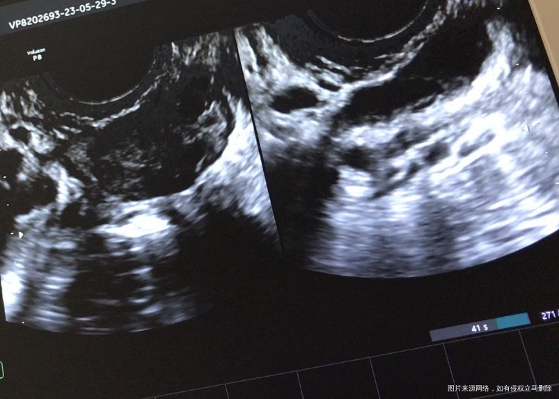 月经期查b超见图片是否提示输卵管积水还有什么