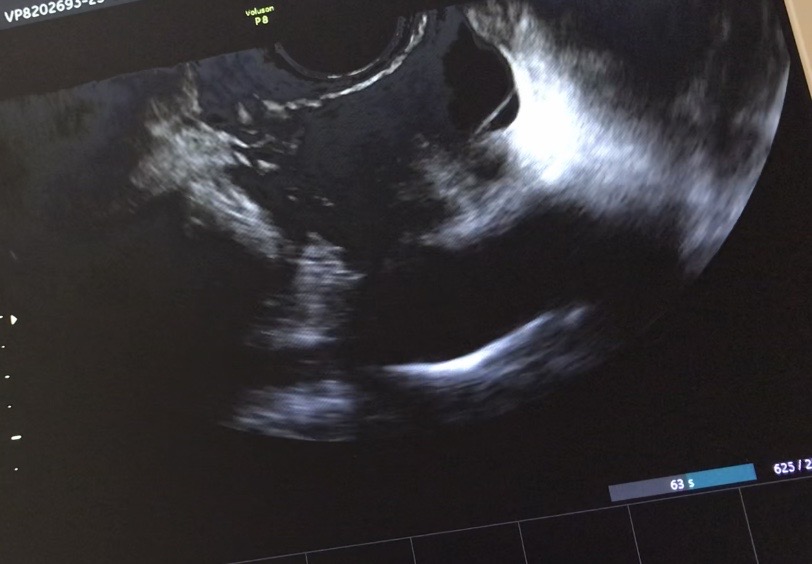 月经期查b超见图片是否提示输卵管积水还有什么