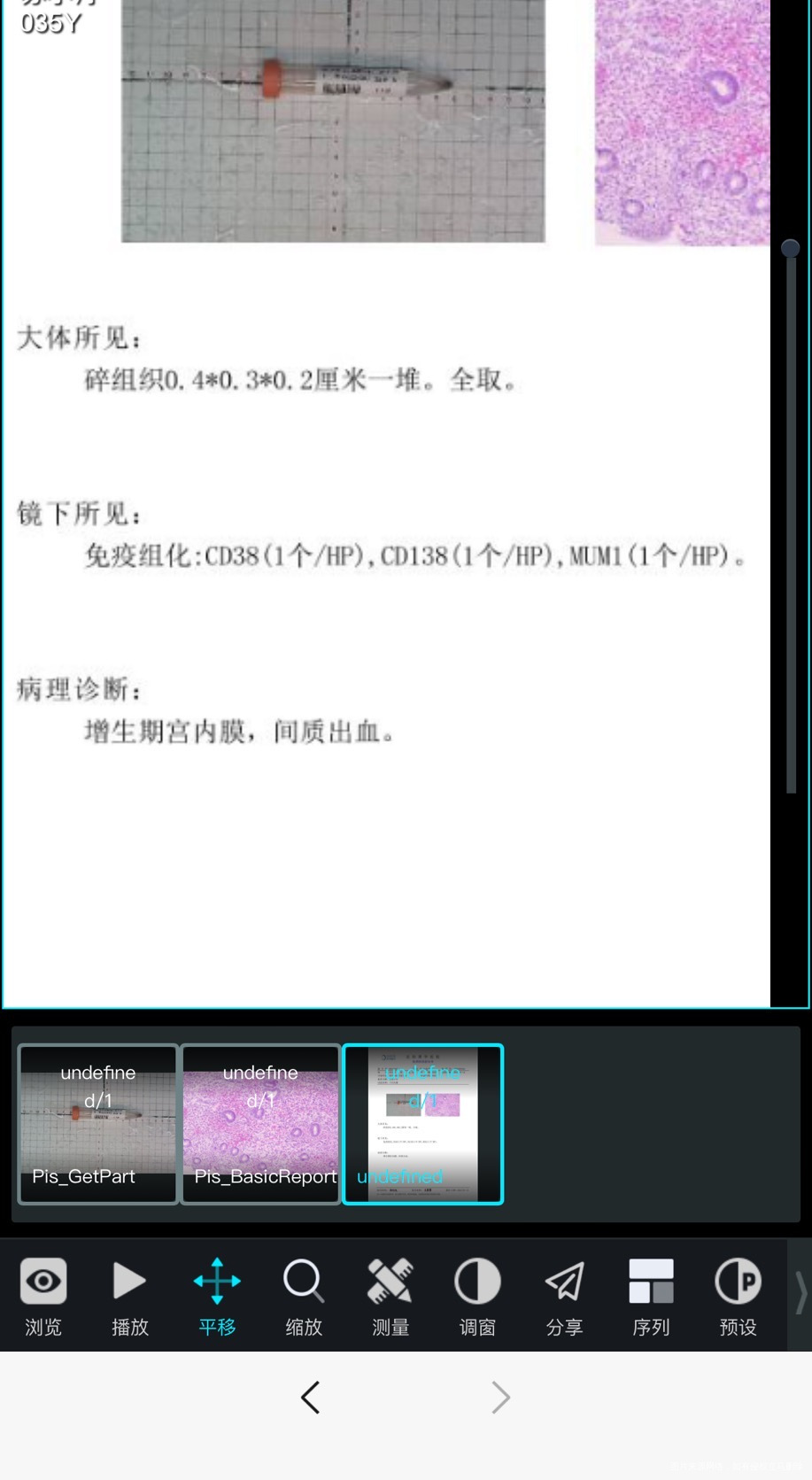 宫腔镜病理请问有问题么
