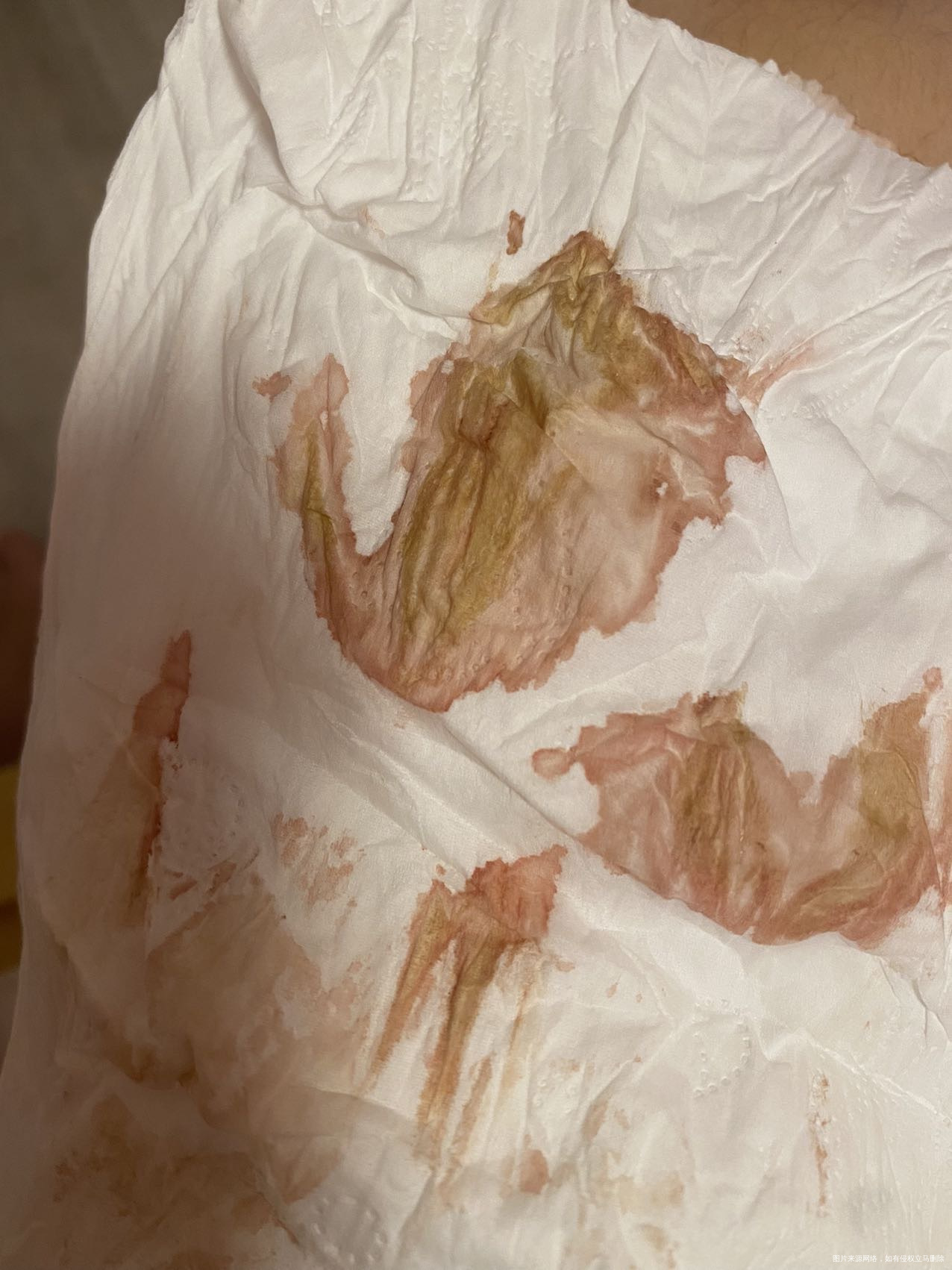 剖腹产一个礼拜下面流这种正常吗