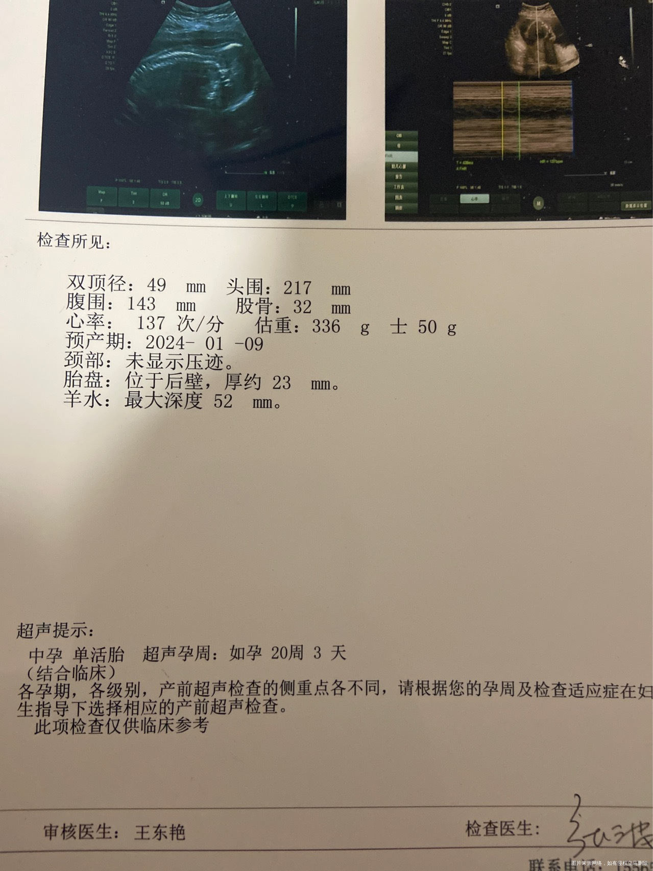 医生请帮我看看我的B超单这个宝宝头围太大了要