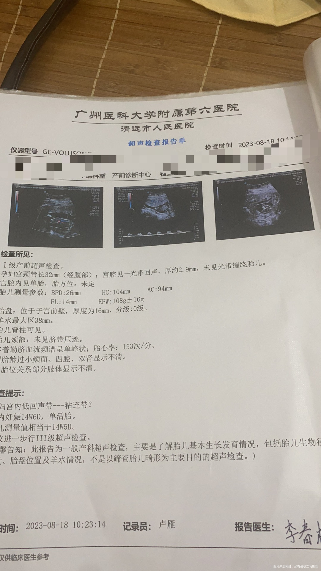 孕15周显示脐血流频谱呈单峰状网上说是染色体