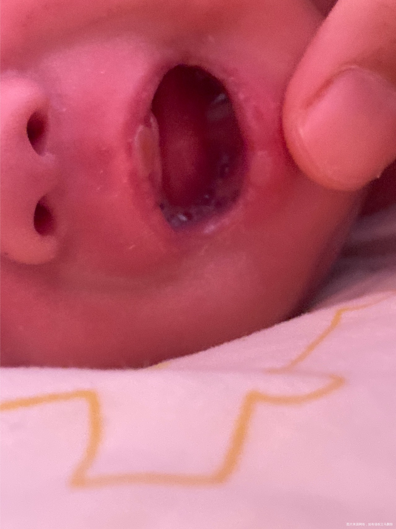新生儿喝完奶嘴巴都是这种小泡泡正常吗