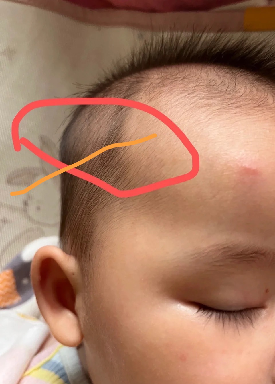 二个多月宝宝耳朵上面骨头硬突出来的需要压下去