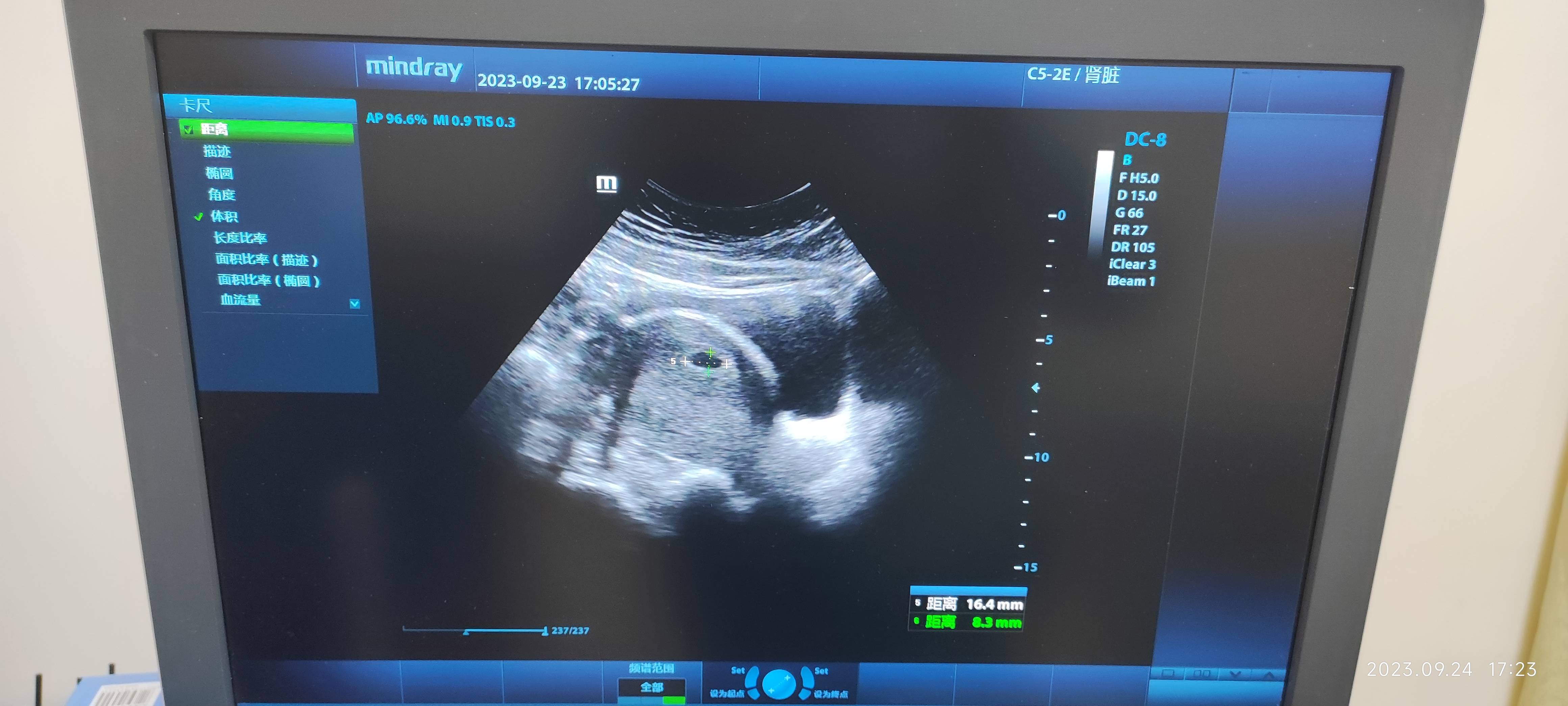 麻烦大夫帮忙看一下这个现在是什么情况