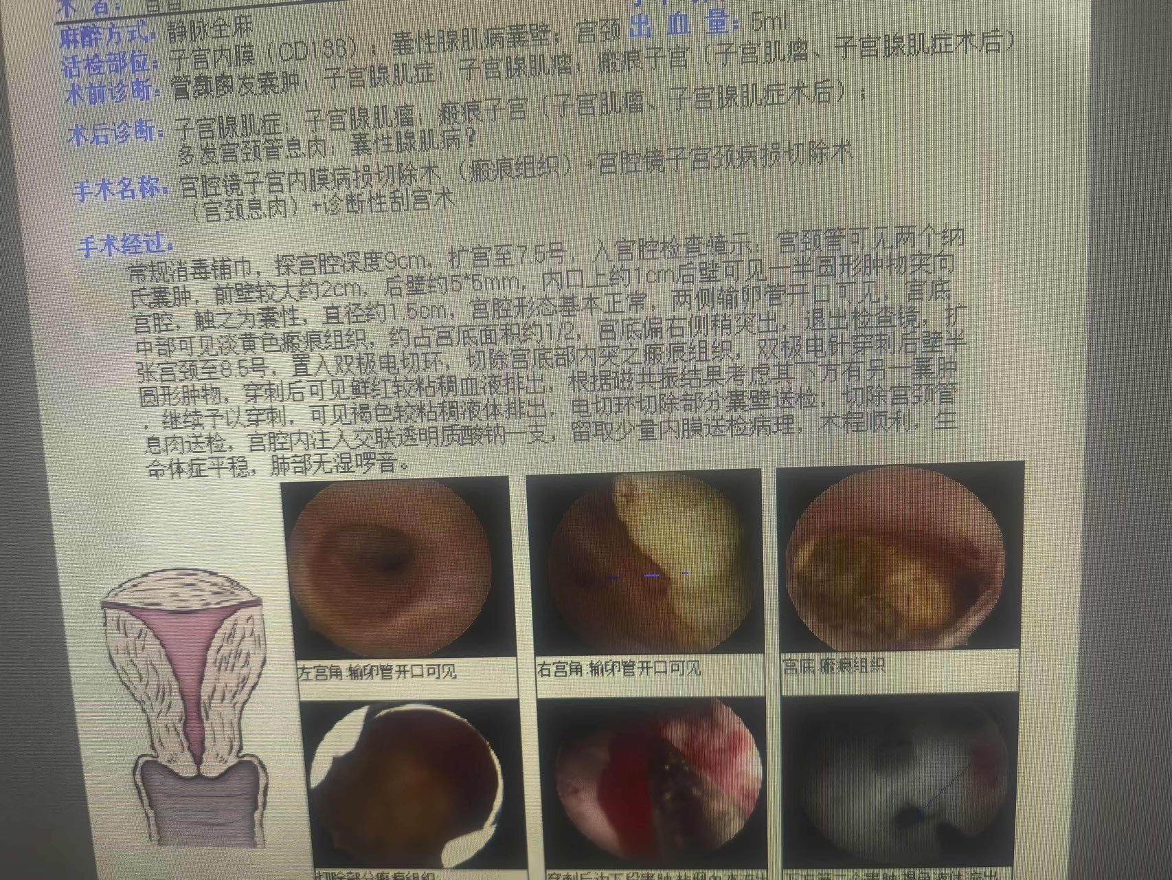 医生您好我是腺肌症试管存了胚胎后没有移植做了