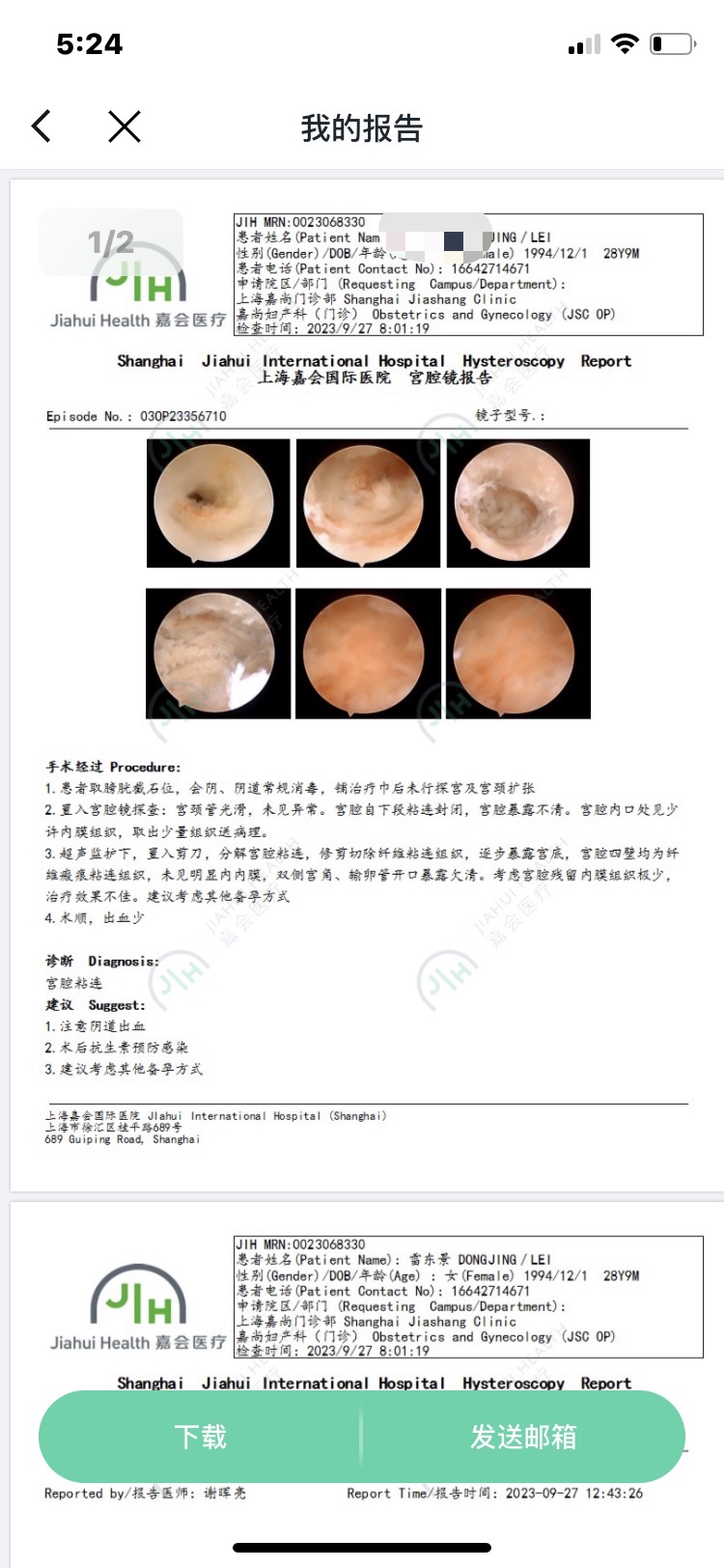 有子宫内膜结核宫腔粘连从没怀过孕