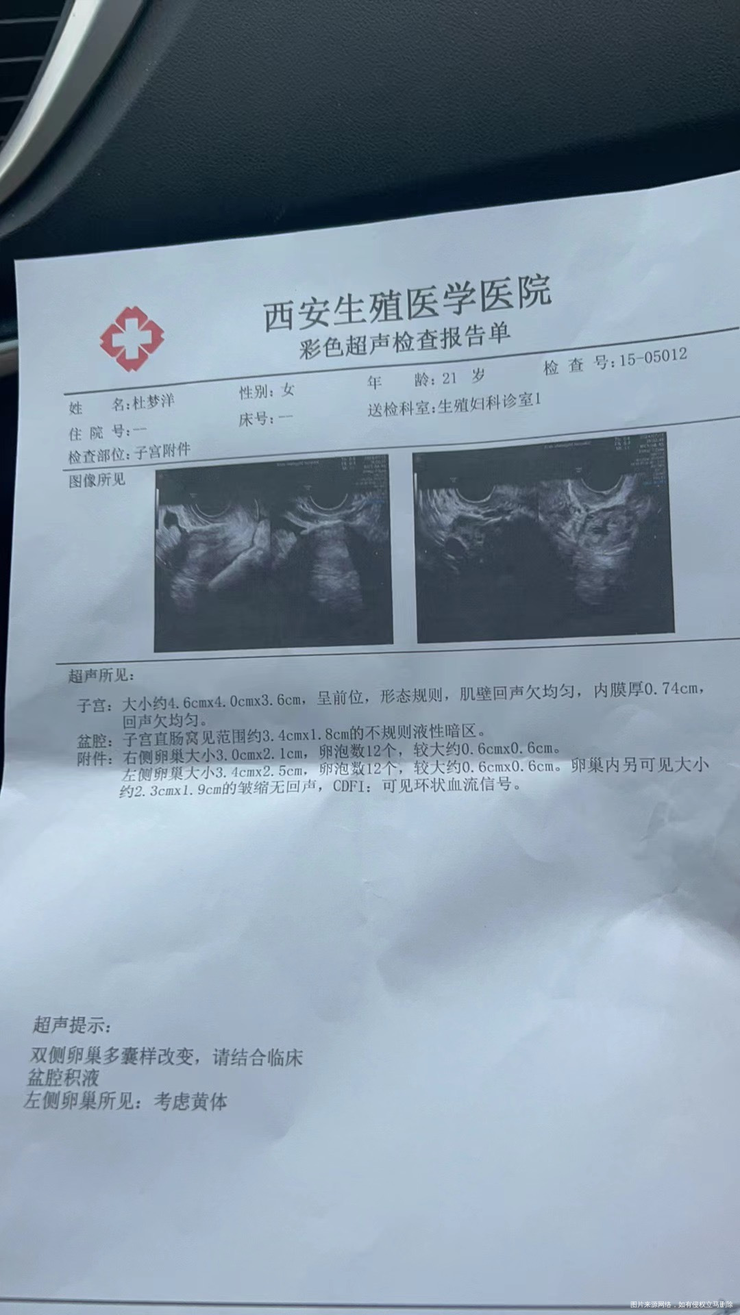 问下这个是排卵了吗医生