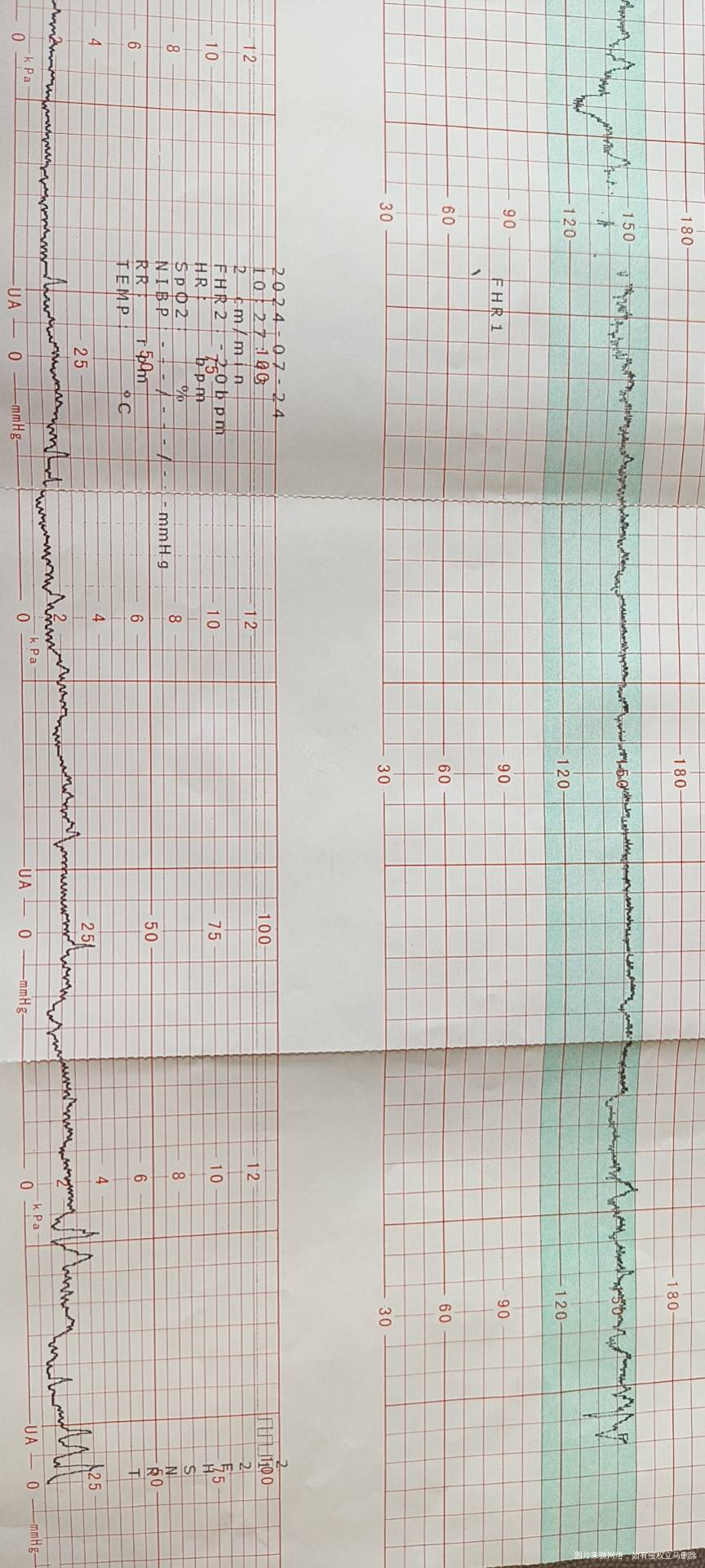 麻烦帮忙看一下这个胎心监护