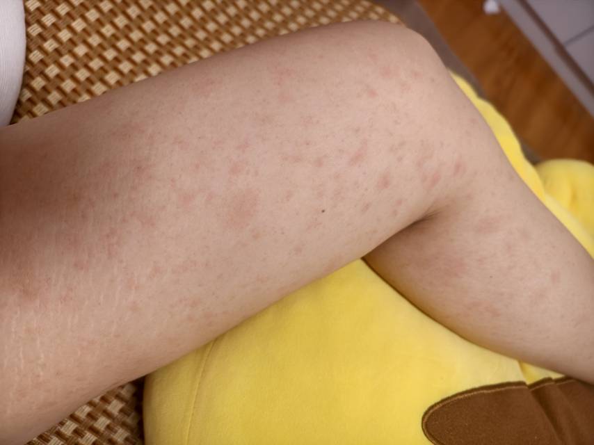 目前孕15周从3周前两个大腿内侧开始长疹子但