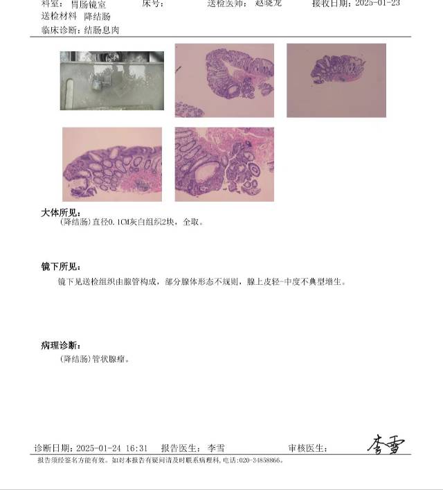 前天做的肠镜发现一个息肉已经割除了这是病理结
