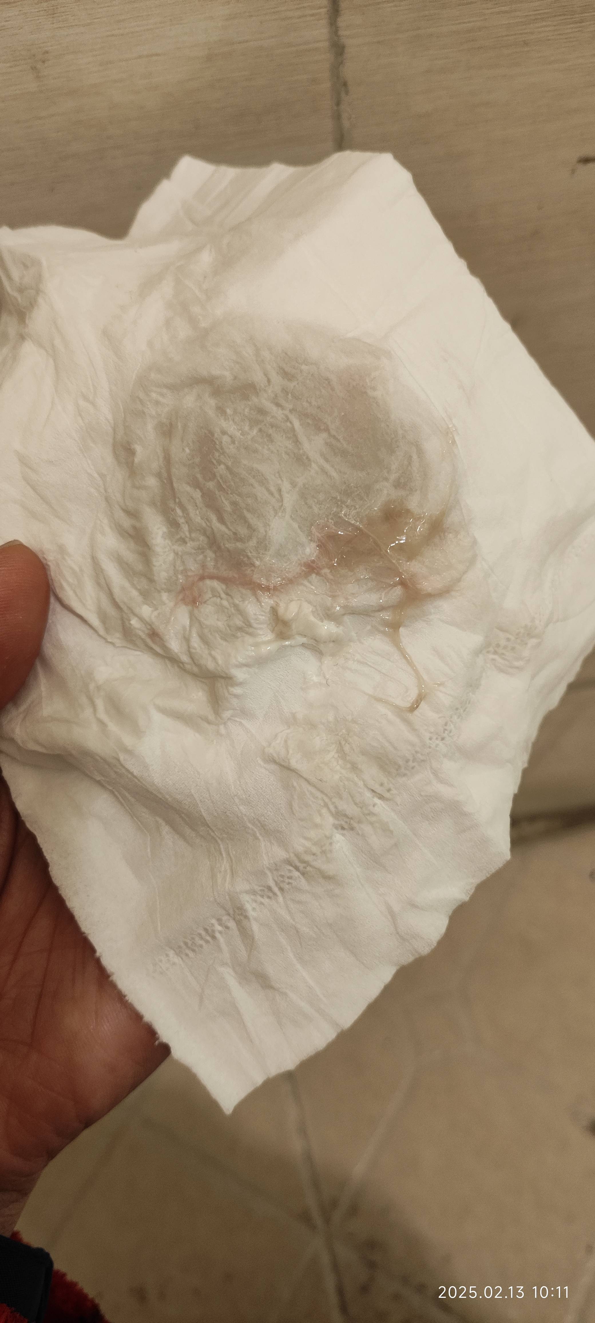 我是2025年1月25日移植的最近发现有这个